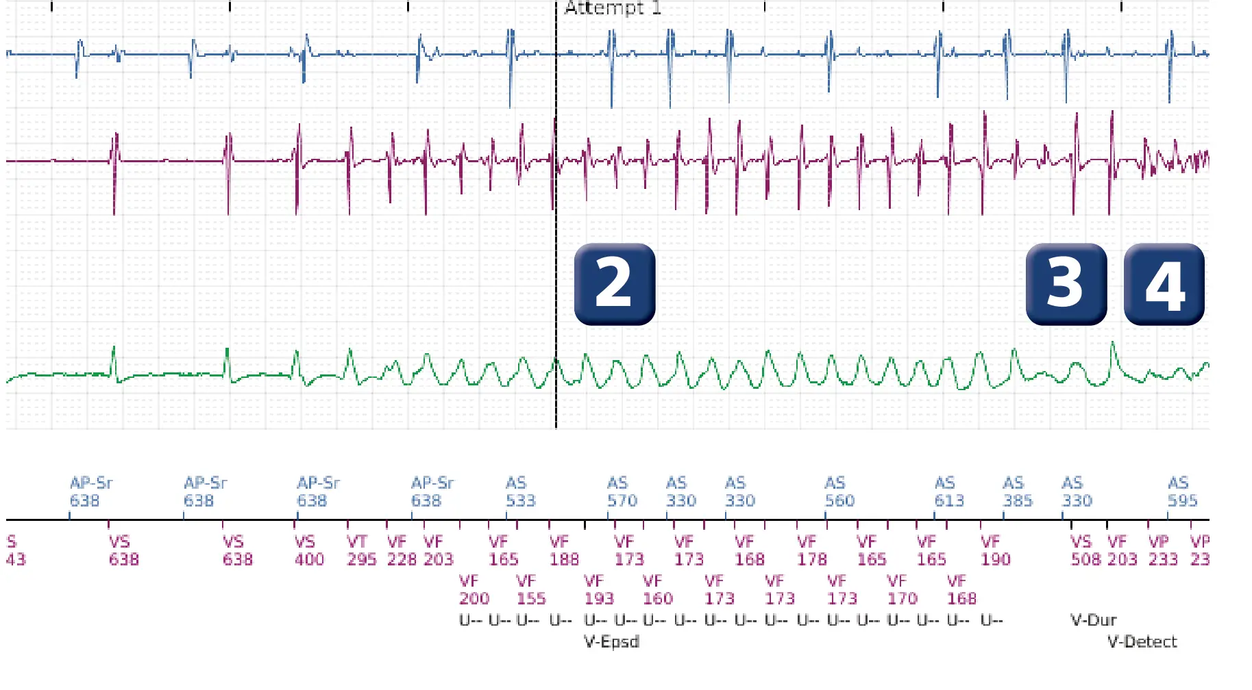 Boston Scientific ICD electrogram, segment 2 of 5 — Undersensing, rate calculation error and ATP burst in the VF zone
