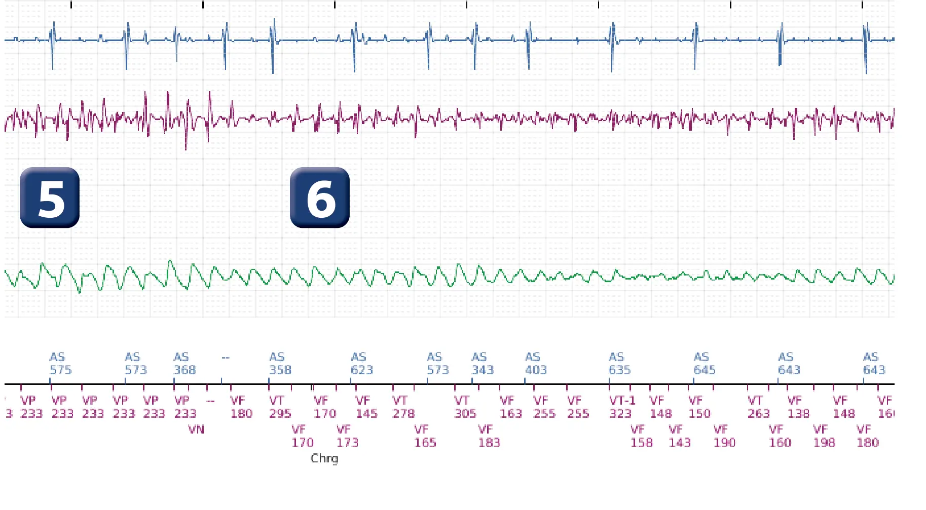 Boston Scientific ICD electrogram, segment 3 of 5 — Undersensing, rate calculation error and ATP burst in the VF zone