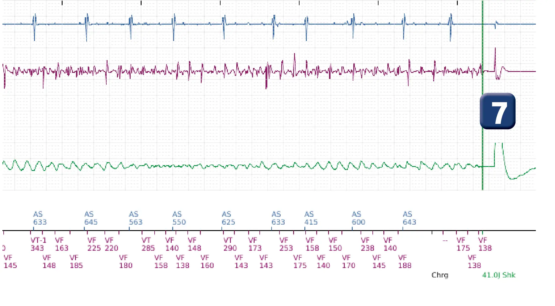 Boston Scientific ICD electrogram, segment 4 of 5 — Undersensing, rate calculation error and ATP burst in the VF zone