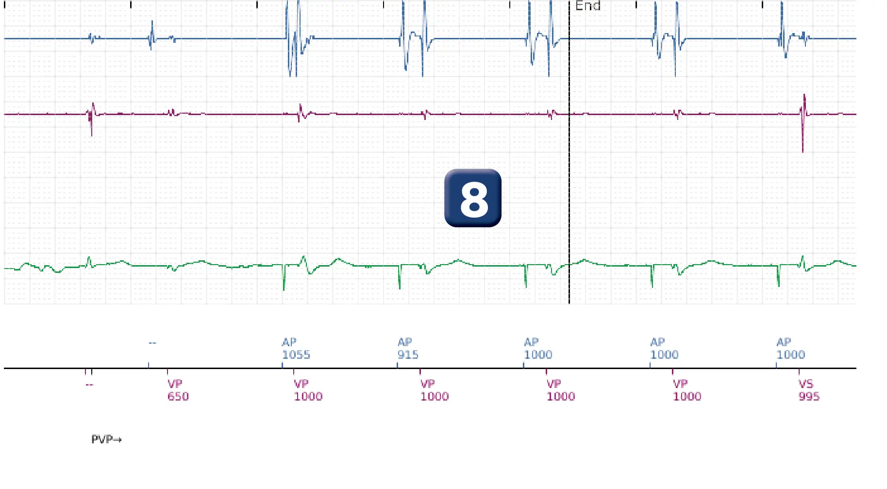Boston Scientific ICD electrogram, segment 5 of 5 — Undersensing, rate calculation error and ATP burst in the VF zone
