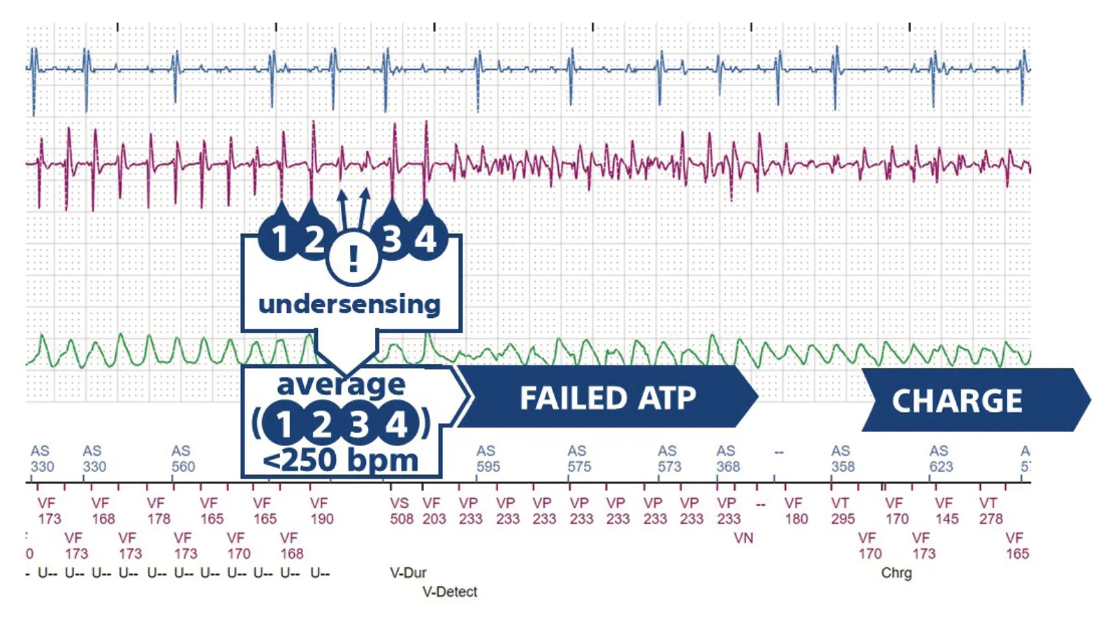 This figure shows the 4 cycles preceding the V-Detect marker and the undersensing which distorts the rate calculation, this is followed by ATP without ventricular capture; the cycle following the ATP is unclassified (--); the ATP is ineffective, after 2 rapid cycles (VF then VT), capacitor charging begins.