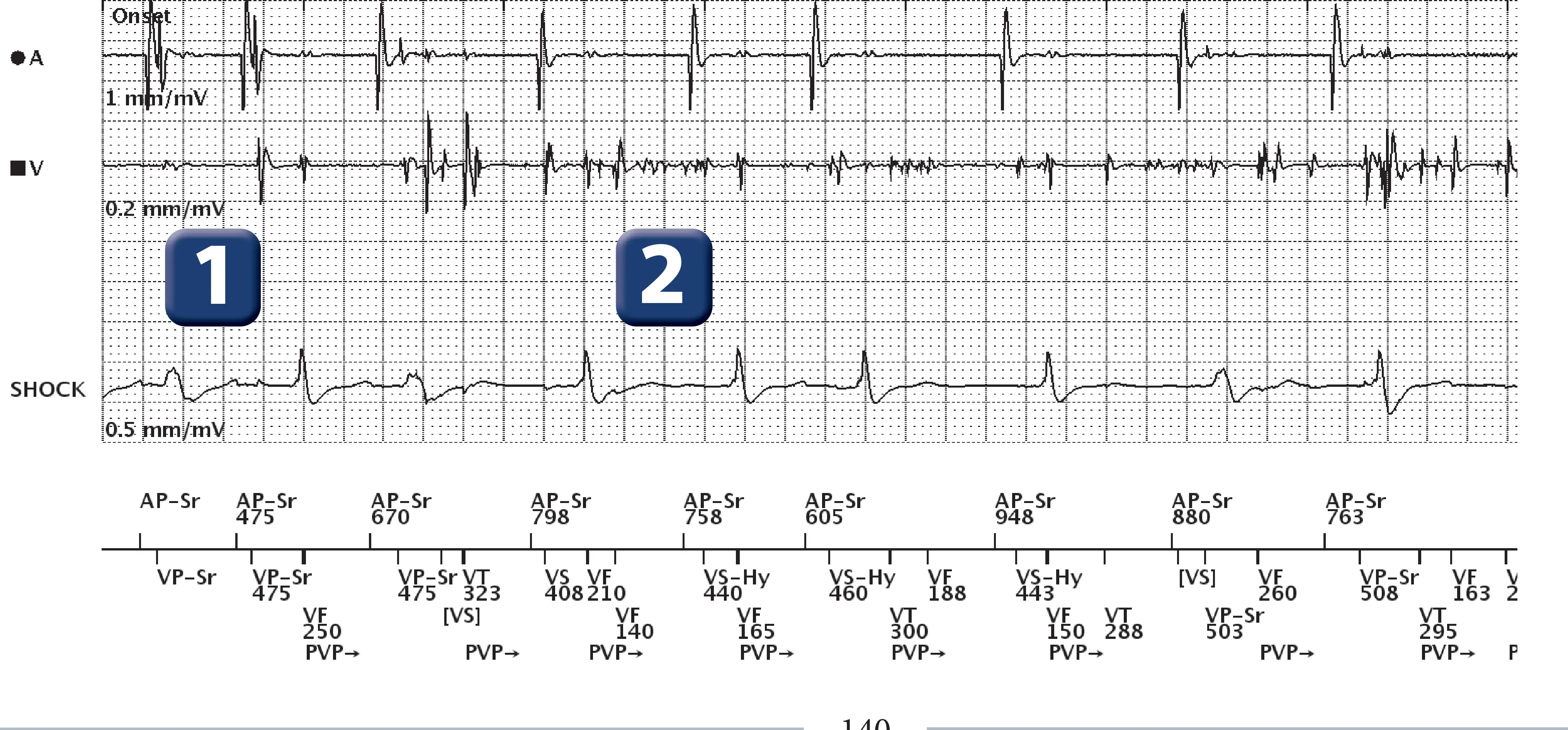 Boston Scientific ICD electrogram, segment 1 of 6 — Oversensing and anti-tachycardia pacing in the VF zone