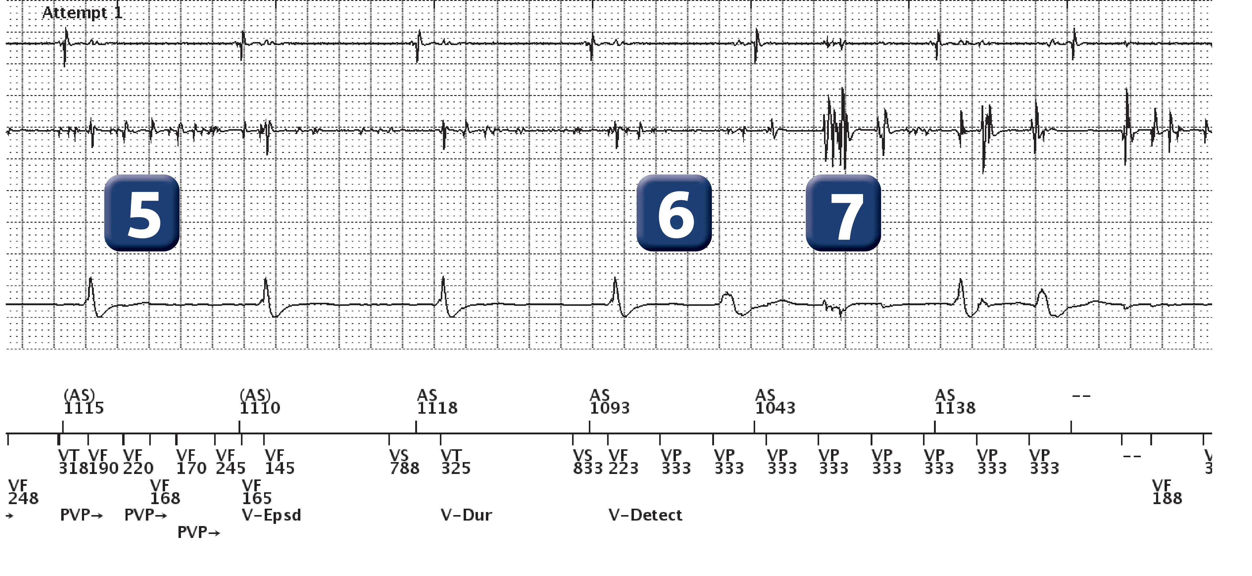 Boston Scientific ICD electrogram, segment 4 of 6 — Oversensing and anti-tachycardia pacing in the VF zone