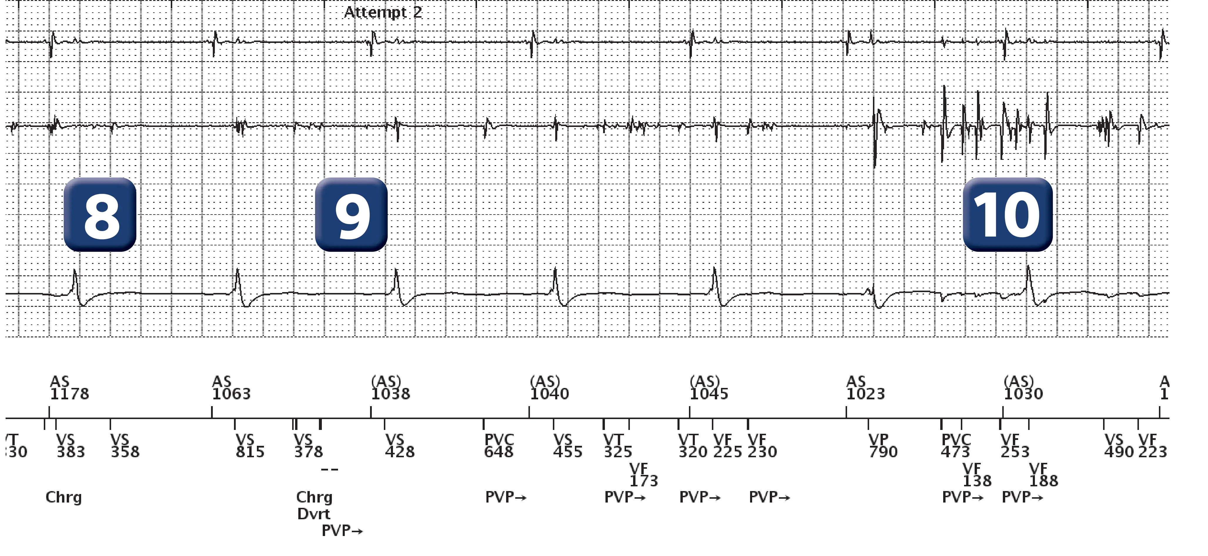 Boston Scientific ICD electrogram, segment 5 of 6 — Oversensing and anti-tachycardia pacing in the VF zone