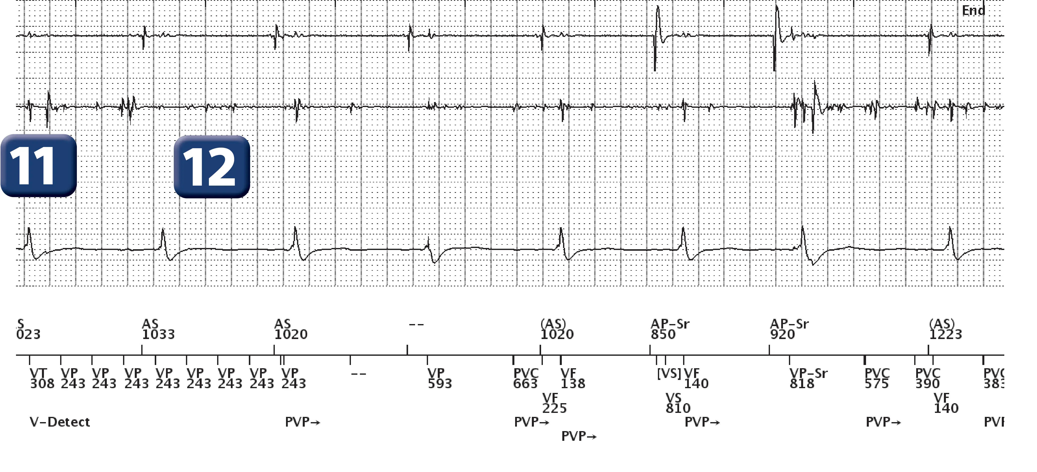 Boston Scientific ICD electrogram, segment 6 of 6 — Oversensing and anti-tachycardia pacing in the VF zone