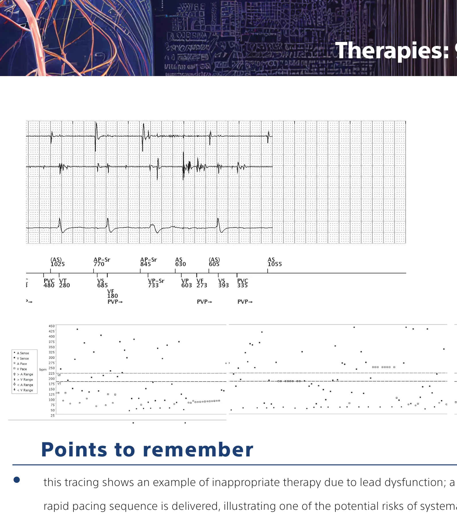 Figure — Oversensing and anti-tachycardia pacing in the VF zone