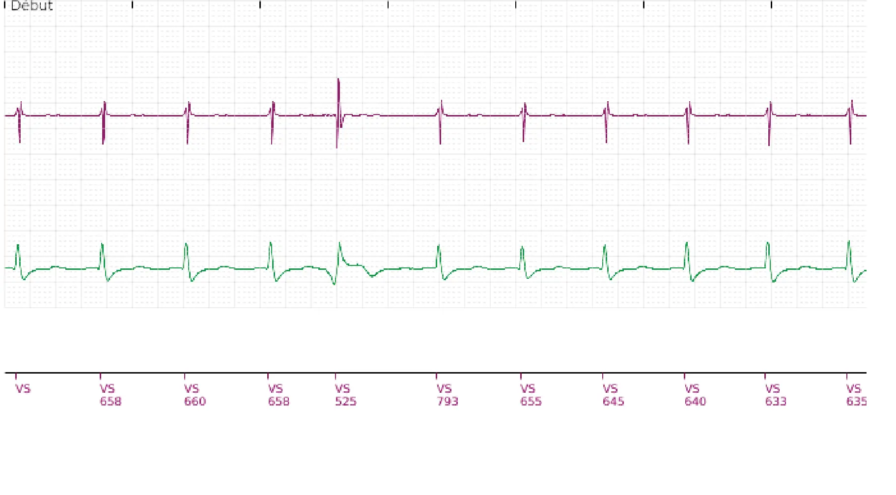 Boston Scientific ICD electrogram, segment 1 of 5 — Single-chamber discrimination, Rhythm ID and a ventricular tachycardia episode