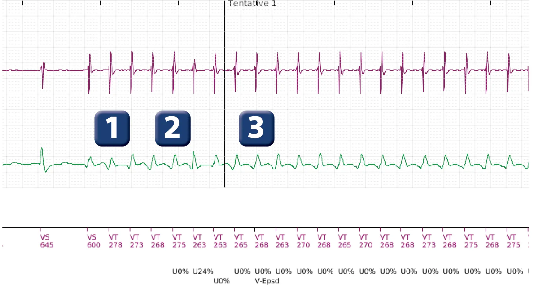 Boston Scientific ICD electrogram, segment 2 of 5 — Single-chamber discrimination, Rhythm ID and a ventricular tachycardia episode