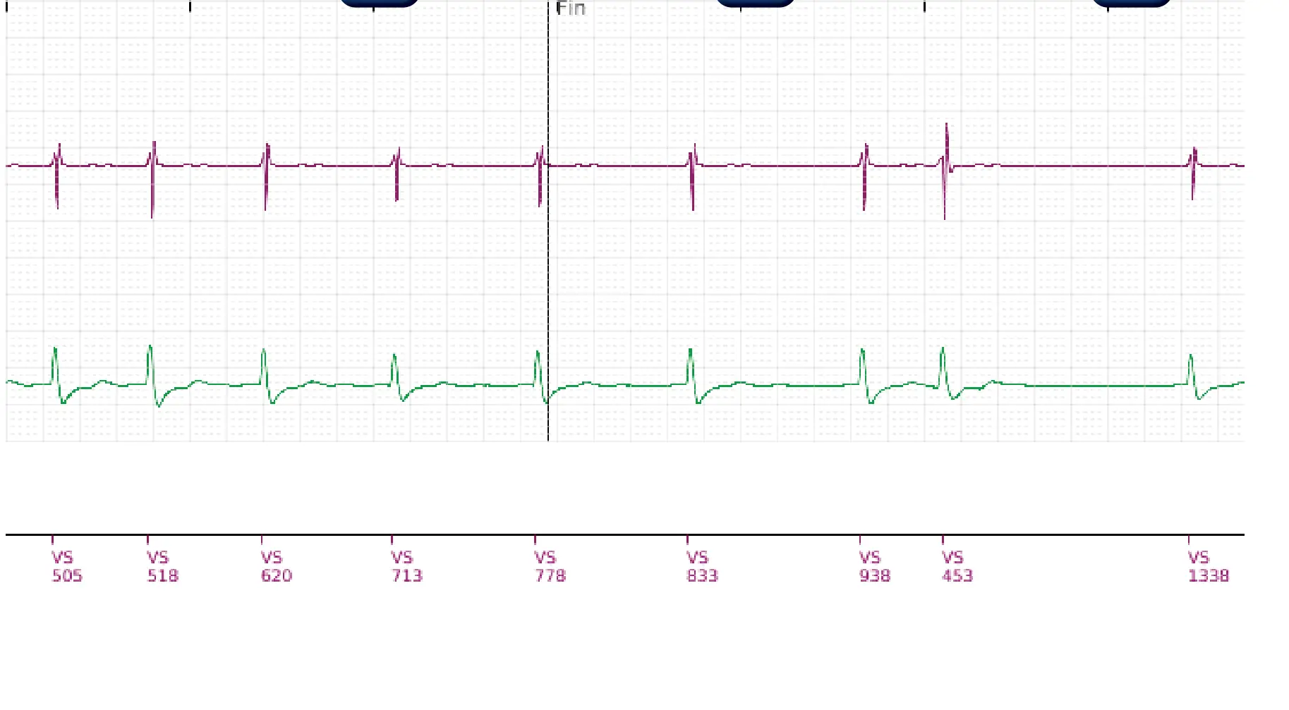 Boston Scientific ICD electrogram, segment 5 of 5 — Single-chamber discrimination, Rhythm ID and a ventricular tachycardia episode