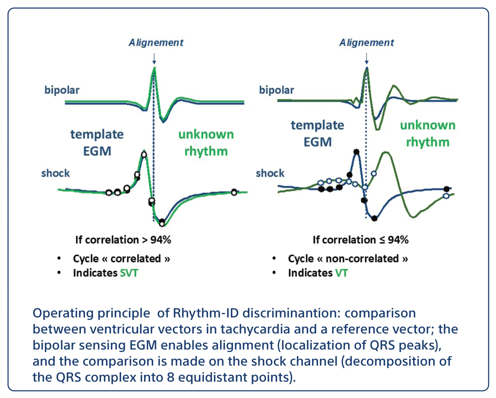 Operating principle of Rhythm-ID discriminantion: comparison between ventricular vectors in tachycardia and a reference vector; the bipolar sensing EGM enables alignment (localization of QRS peaks), and the comparison is made on the shock channel (decomposition of the QRS complex into 8 equidistant points).