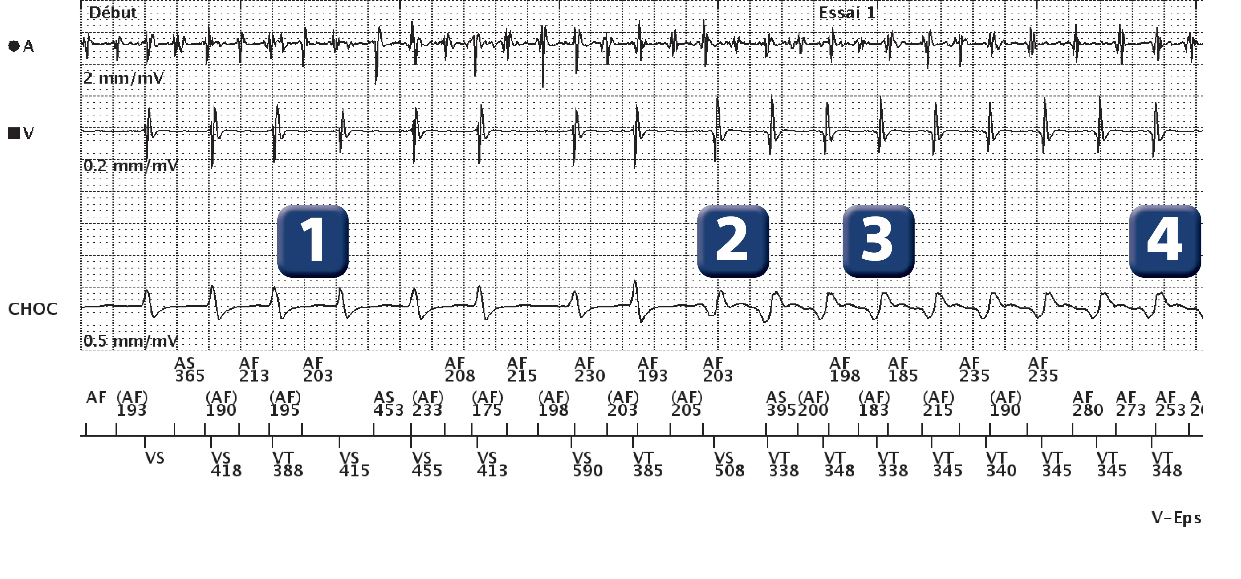 Boston Scientific ICD electrogram, segment 1 of 5 — Dual-chamber discrimination and dual tachycardia