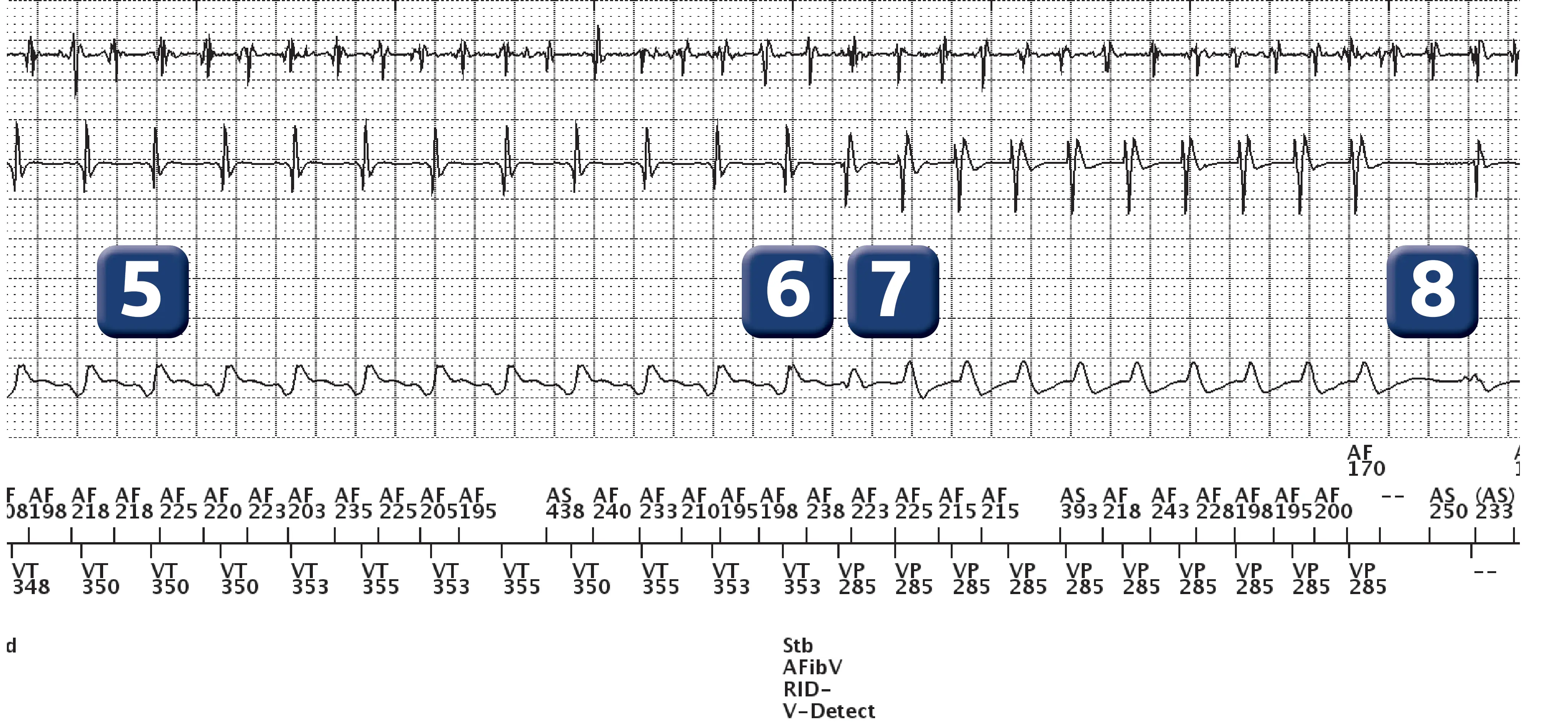 Boston Scientific ICD electrogram, segment 2 of 5 — Dual-chamber discrimination and dual tachycardia