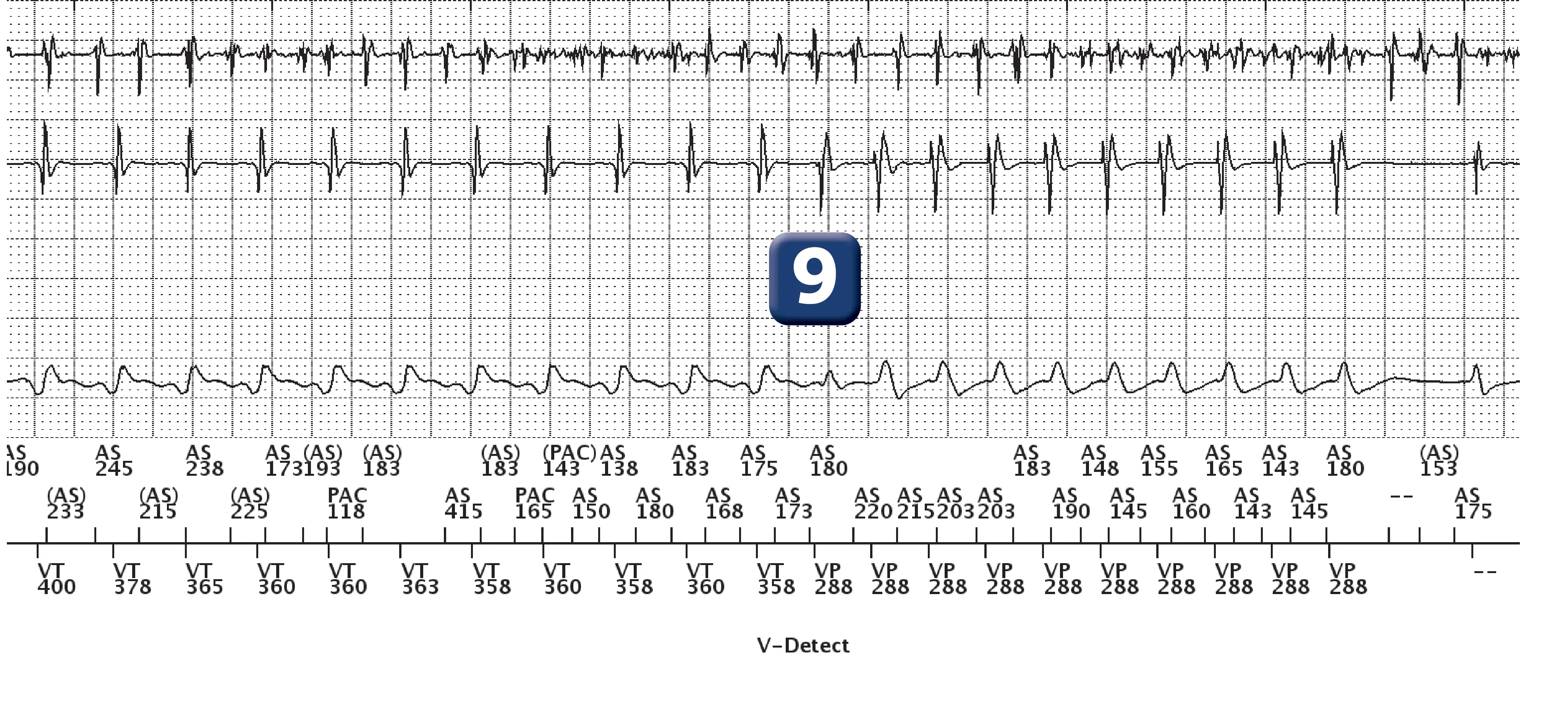 Boston Scientific ICD electrogram, segment 3 of 5 — Dual-chamber discrimination and dual tachycardia