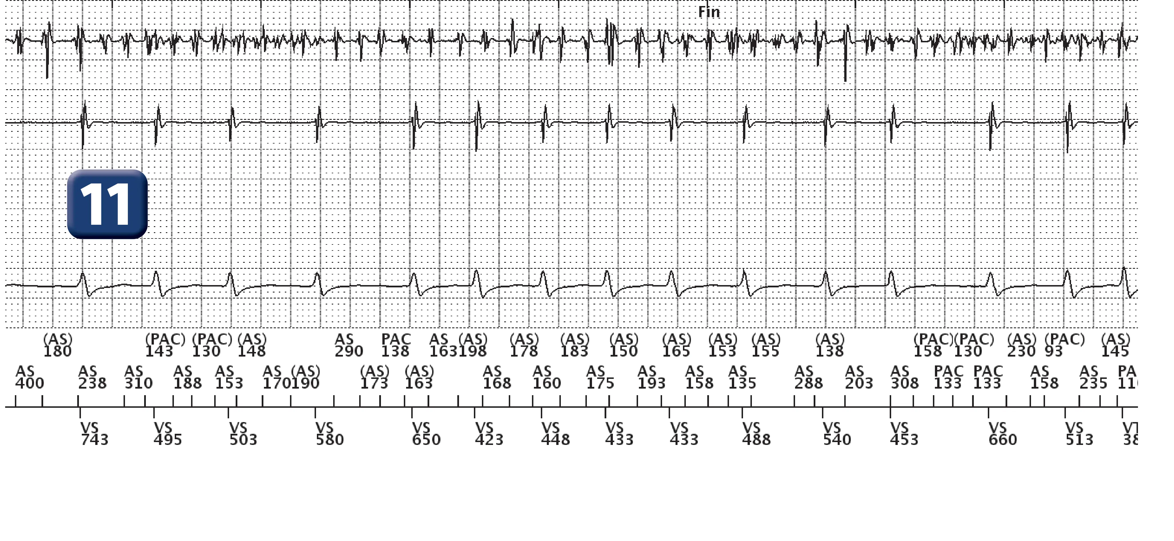 Boston Scientific ICD electrogram, segment 4 of 5 — Dual-chamber discrimination and dual tachycardia