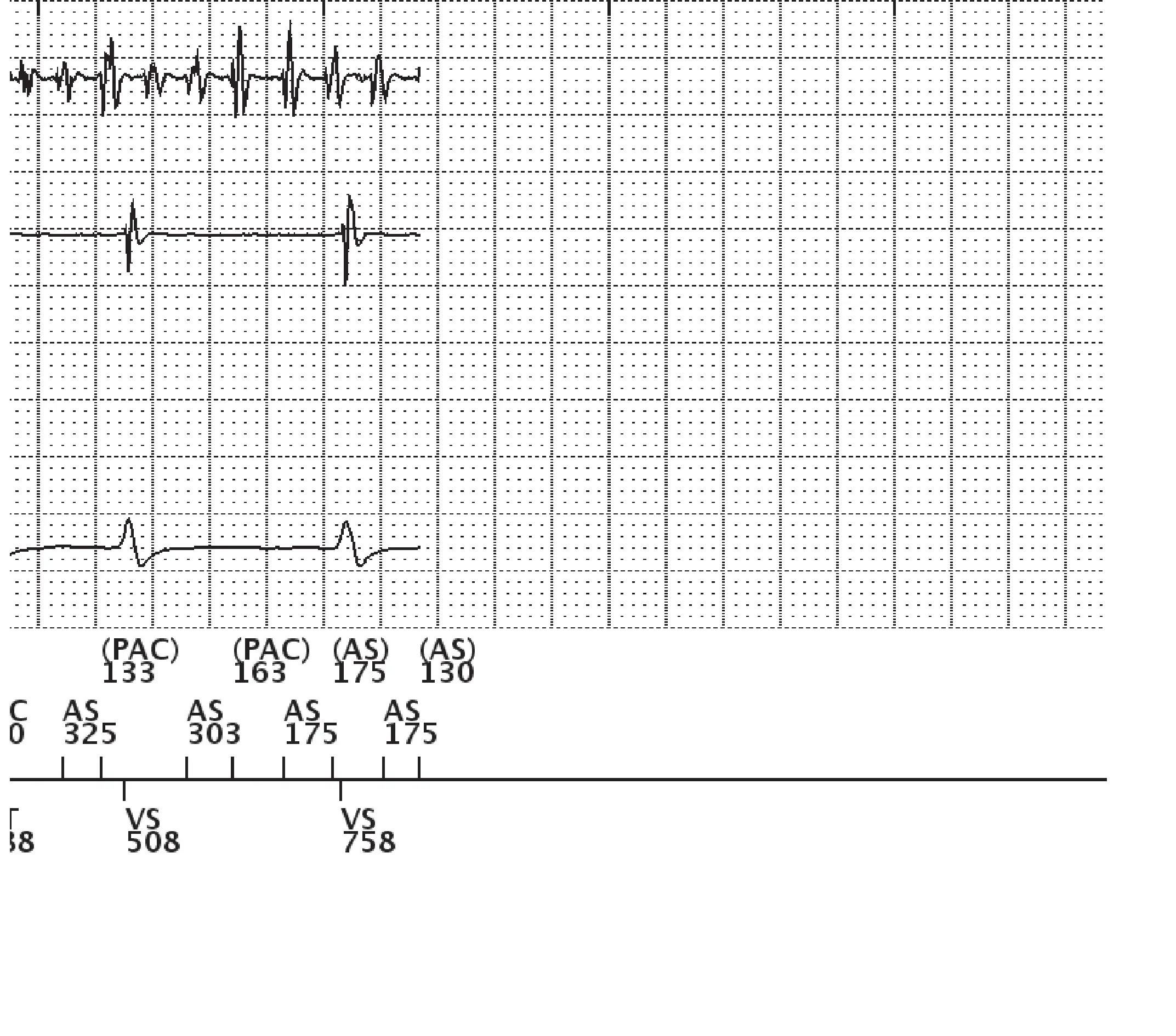 Boston Scientific ICD electrogram, segment 5 of 5 — Dual-chamber discrimination and dual tachycardia