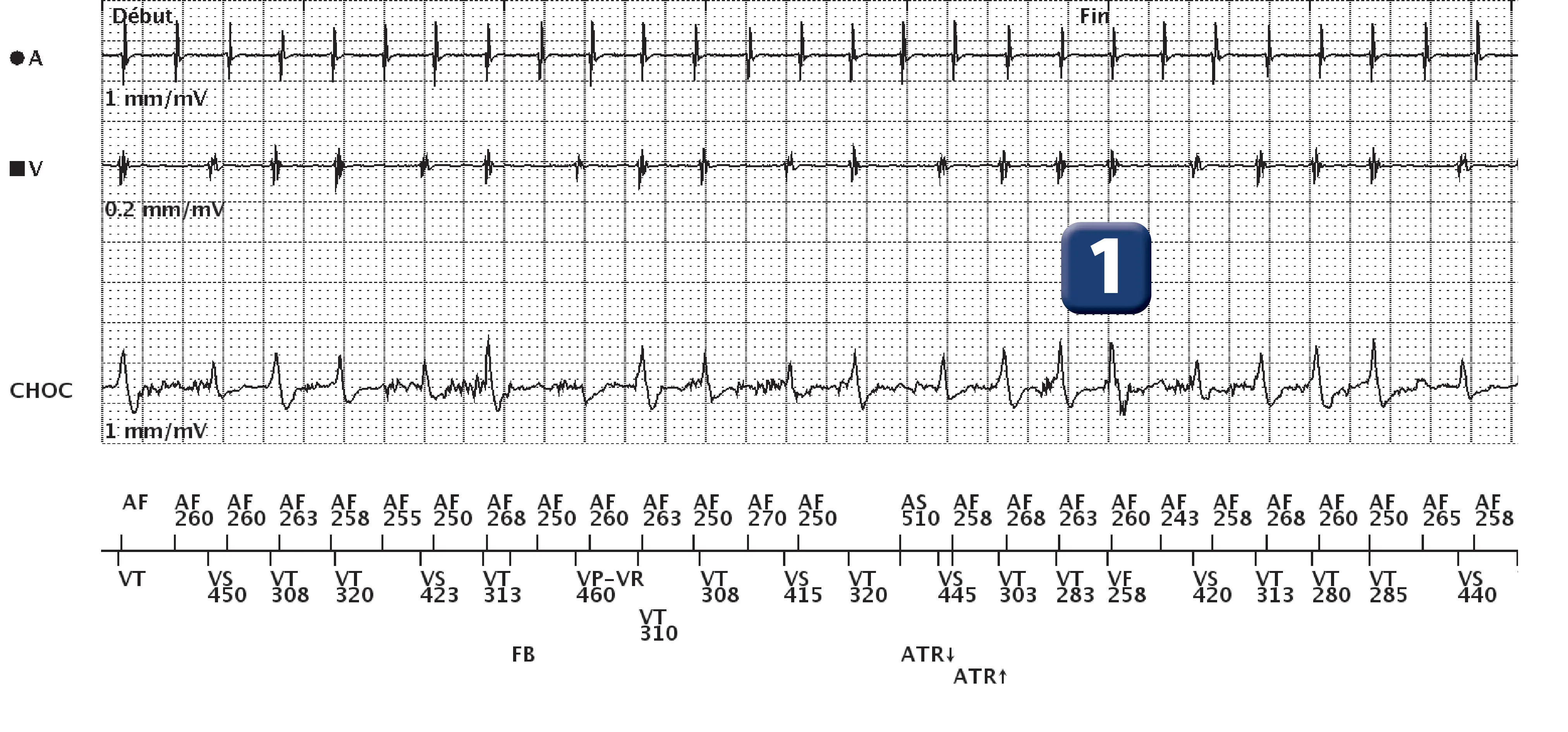 Boston Scientific ICD electrogram, segment 1 of 3 — Dual-chamber discrimination and AF with aberrant conduction