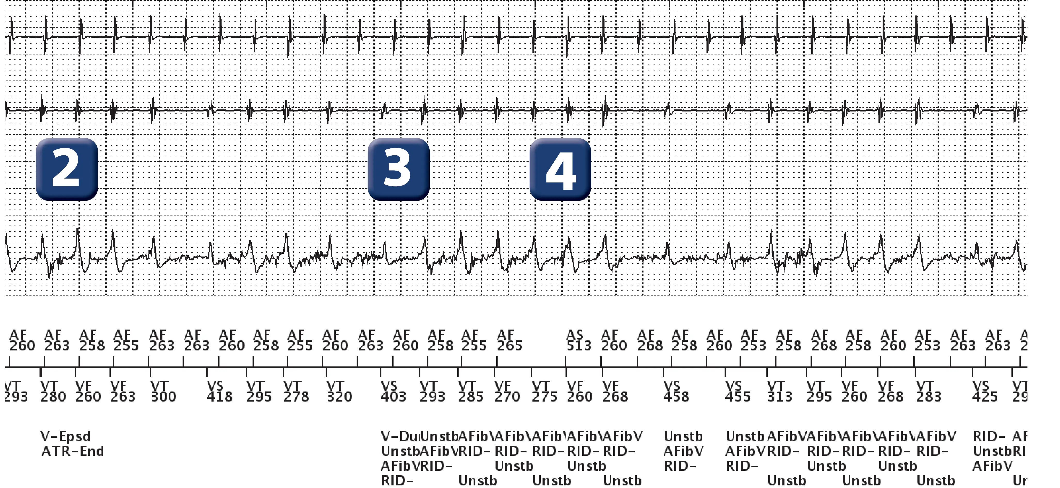 Boston Scientific ICD electrogram, segment 2 of 3 — Dual-chamber discrimination and AF with aberrant conduction