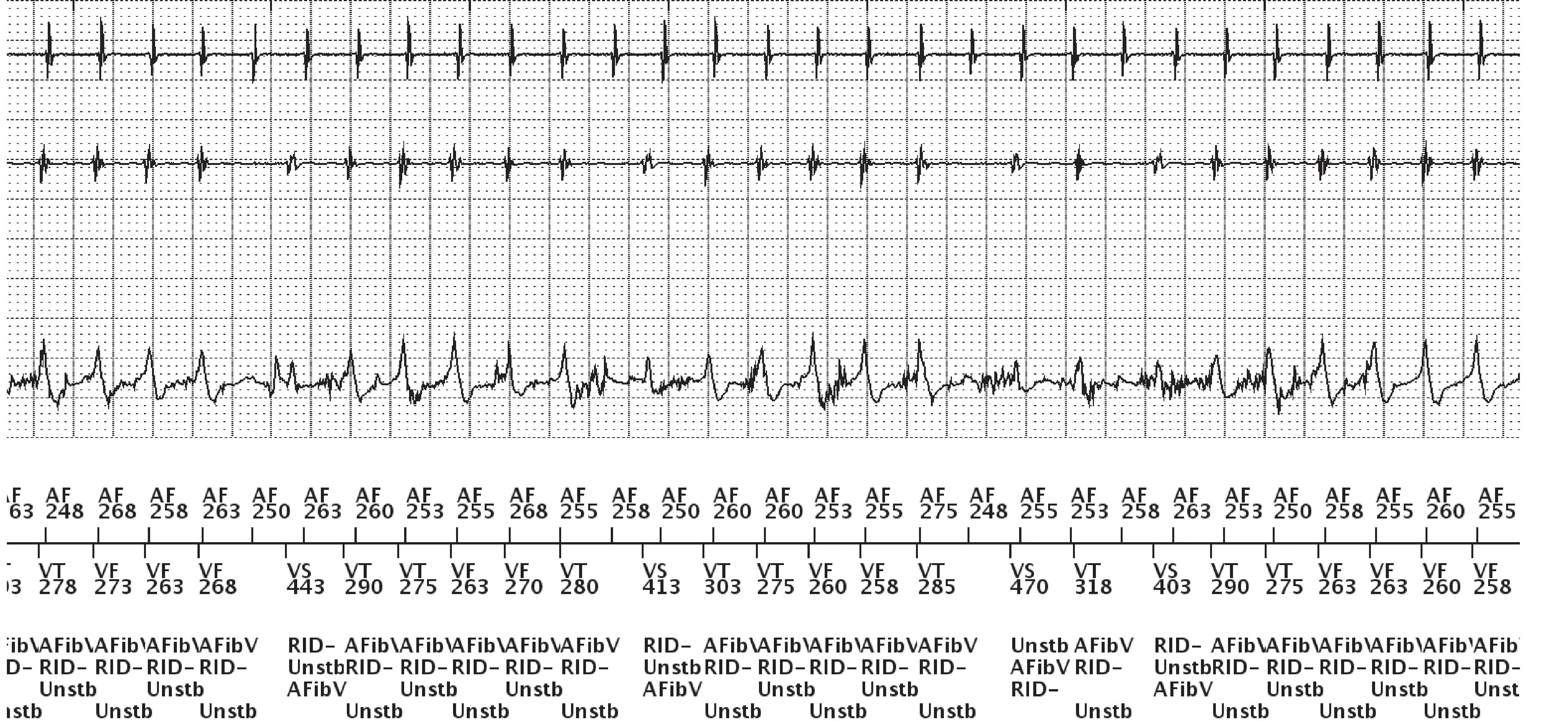 Boston Scientific ICD electrogram, segment 3 of 3 — Dual-chamber discrimination and AF with aberrant conduction