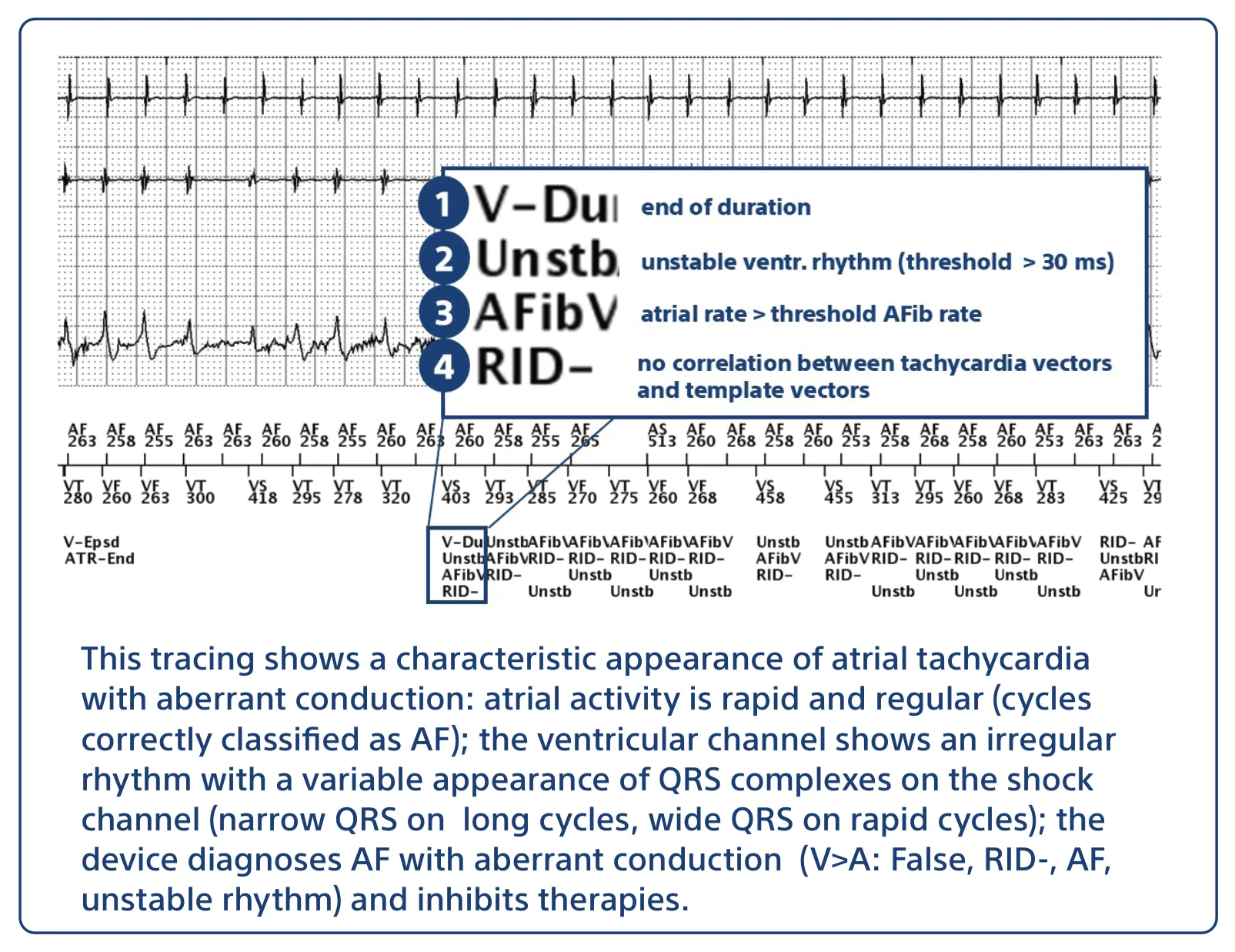This tracing shows a characteristic appearance of atrial tachycardia with aberrant conduction: atrial activity is rapid and regular (cycles correctly classified as AF); the ventricular channel shows an irregular rhythm with a variable appearance of QRS complexes on the shock channel (narrow QRS on long cycles, wide QRS on rapid cycles); the device diagnoses AF with aberrant conduction (V>A: False, RID-, AF, unstable rhythm) and inhibits therapies.