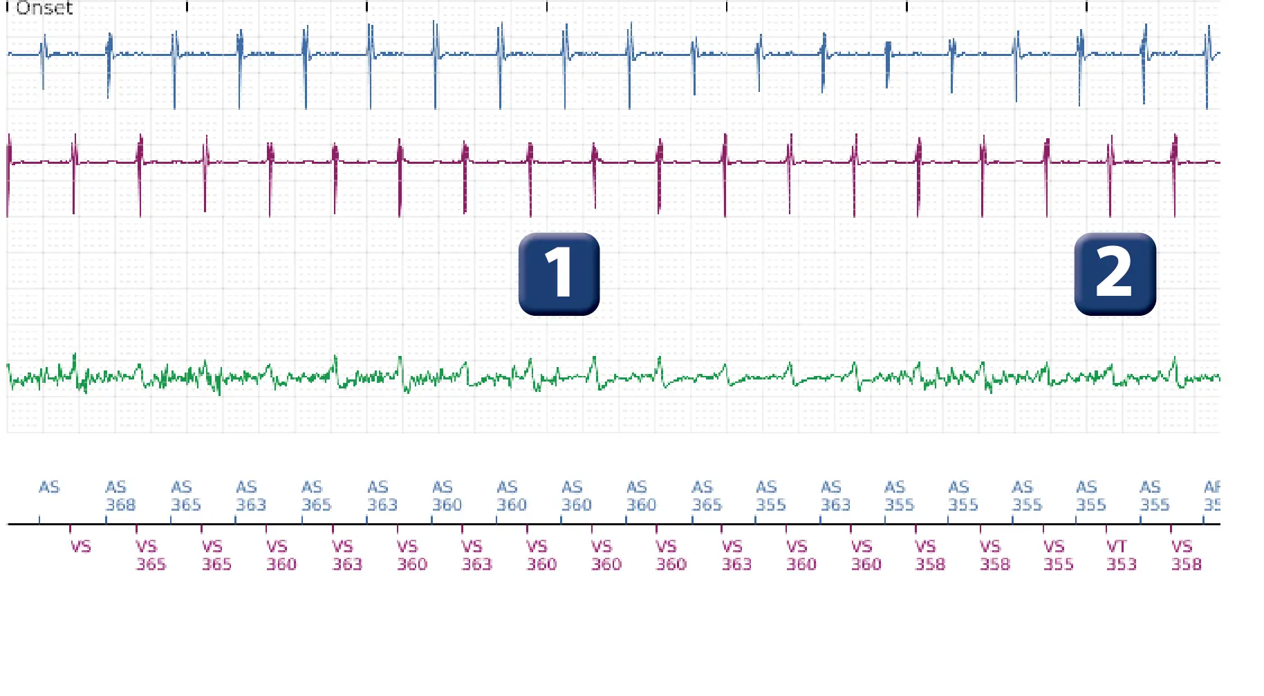 Boston Scientific ICD electrogram, segment 1 of 10 — Dual-chamber discrimination and discrimination error due to signal variability on the shock channel