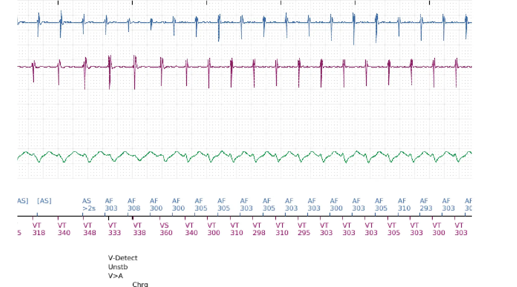 Boston Scientific ICD electrogram, segment 10 of 10 — Dual-chamber discrimination and discrimination error due to signal variability on the shock channel