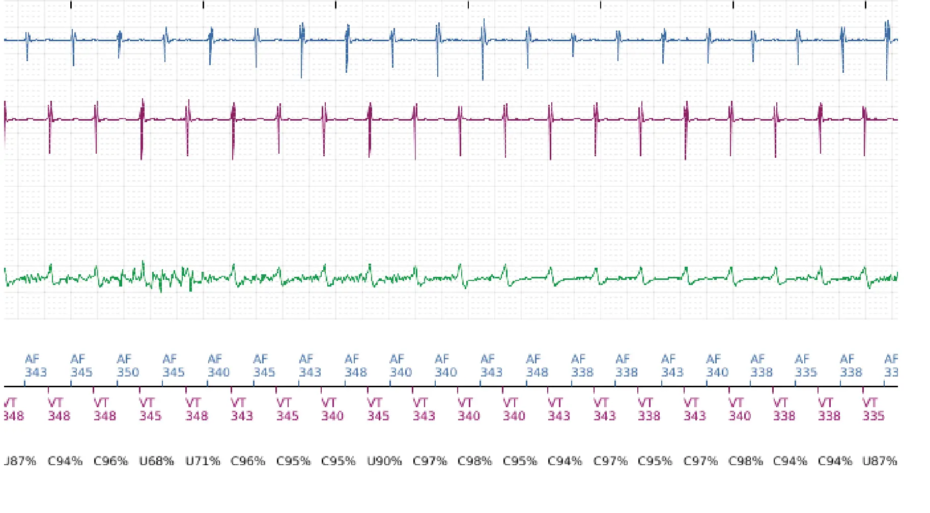 Boston Scientific ICD electrogram, segment 3 of 10 — Dual-chamber discrimination and discrimination error due to signal variability on the shock channel