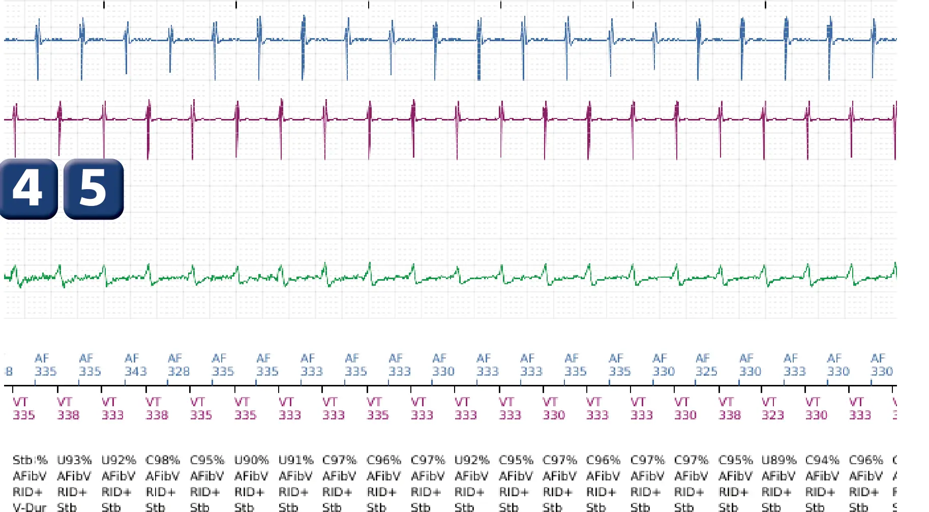 Boston Scientific ICD electrogram, segment 4 of 10 — Dual-chamber discrimination and discrimination error due to signal variability on the shock channel