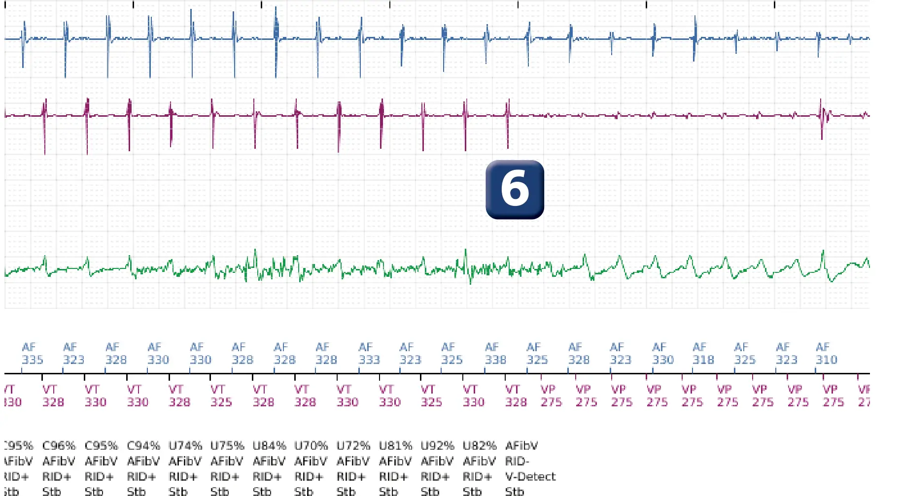 Boston Scientific ICD electrogram, segment 5 of 10 — Dual-chamber discrimination and discrimination error due to signal variability on the shock channel