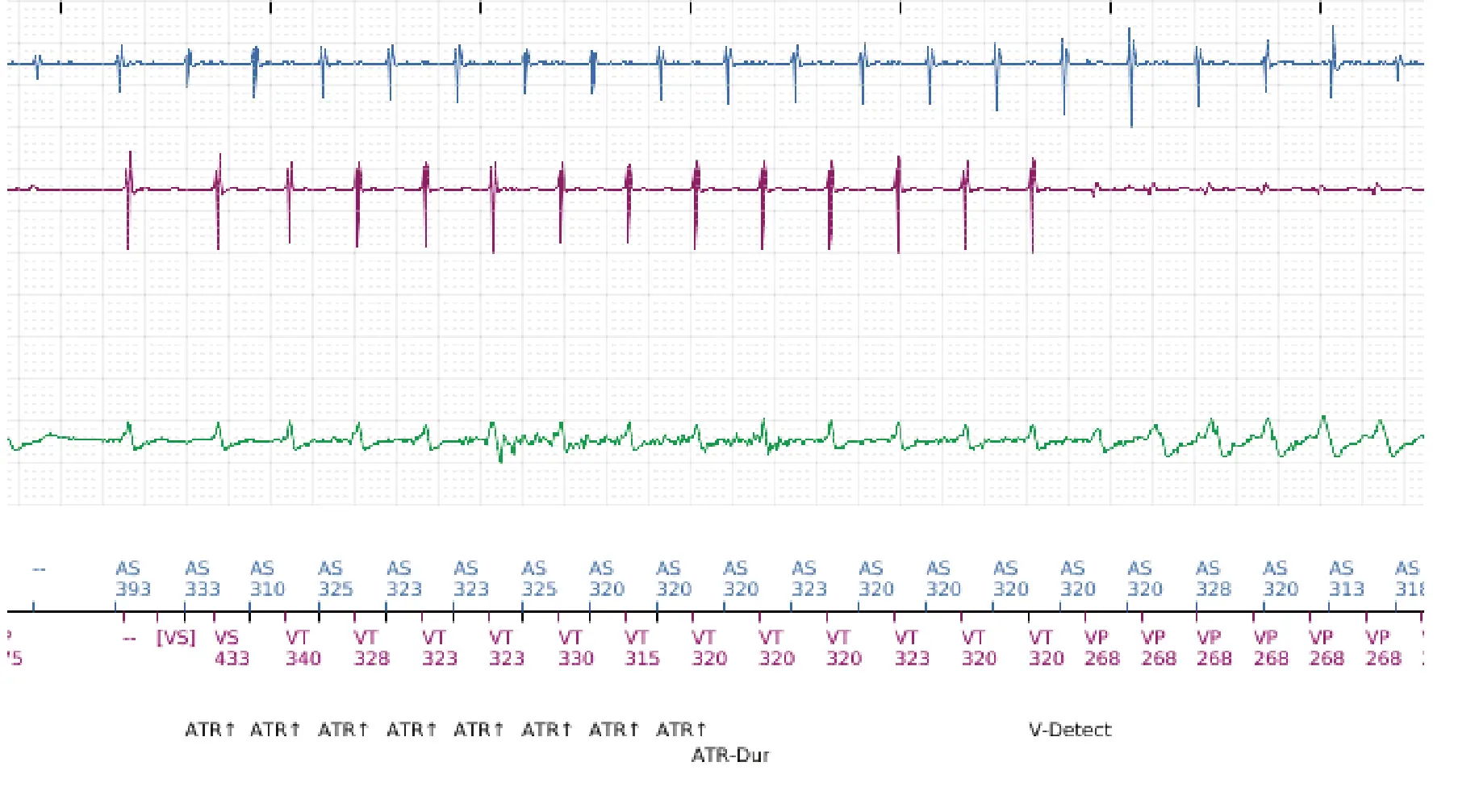 Boston Scientific ICD electrogram, segment 6 of 10 — Dual-chamber discrimination and discrimination error due to signal variability on the shock channel