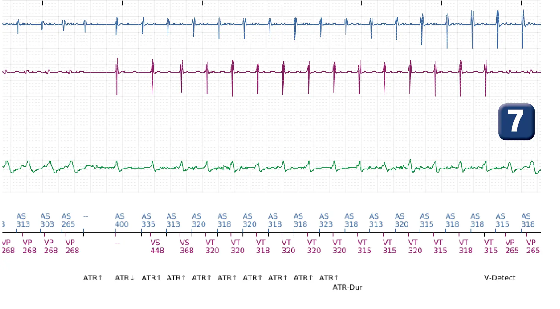 Boston Scientific ICD electrogram, segment 7 of 10 — Dual-chamber discrimination and discrimination error due to signal variability on the shock channel