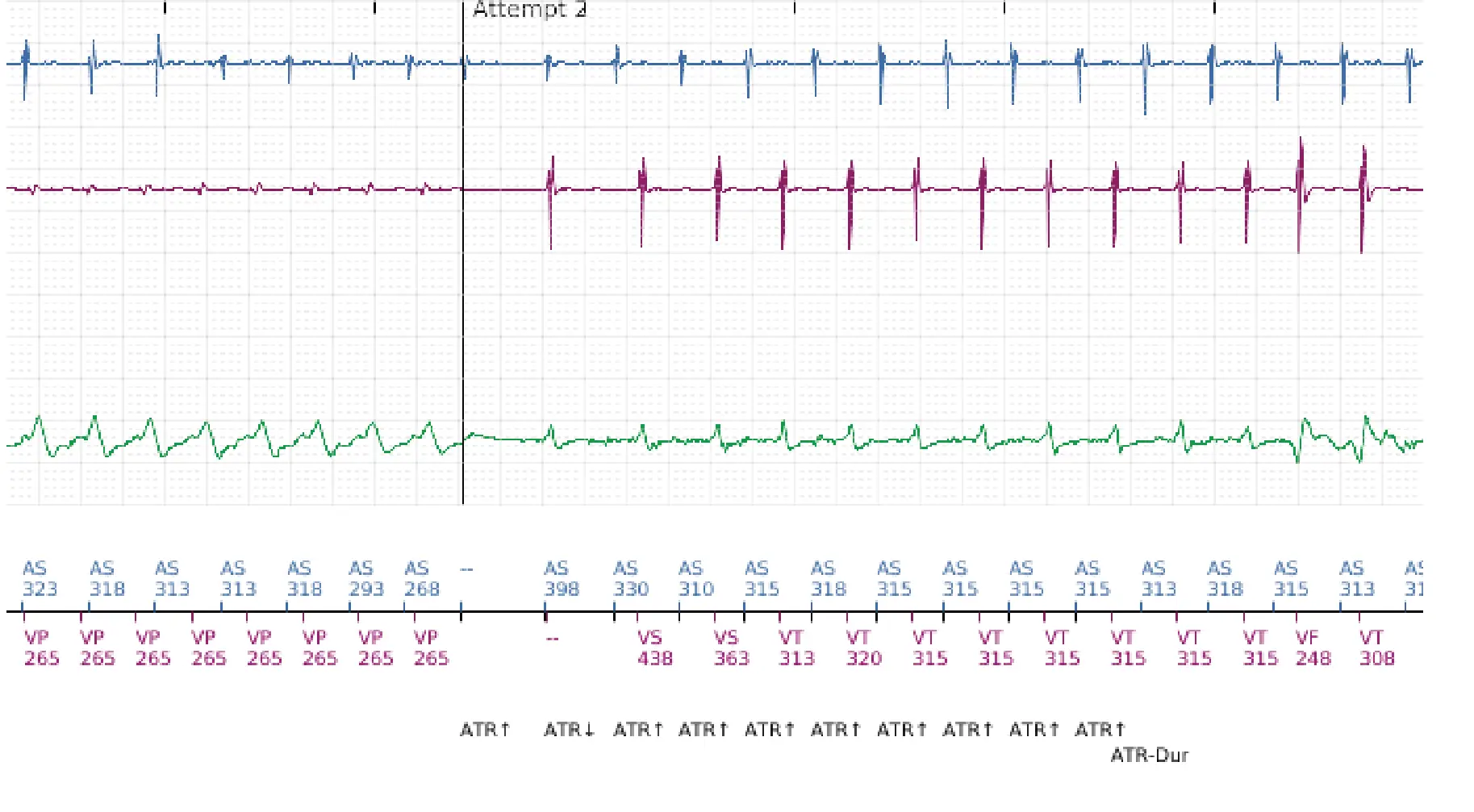 Boston Scientific ICD electrogram, segment 8 of 10 — Dual-chamber discrimination and discrimination error due to signal variability on the shock channel