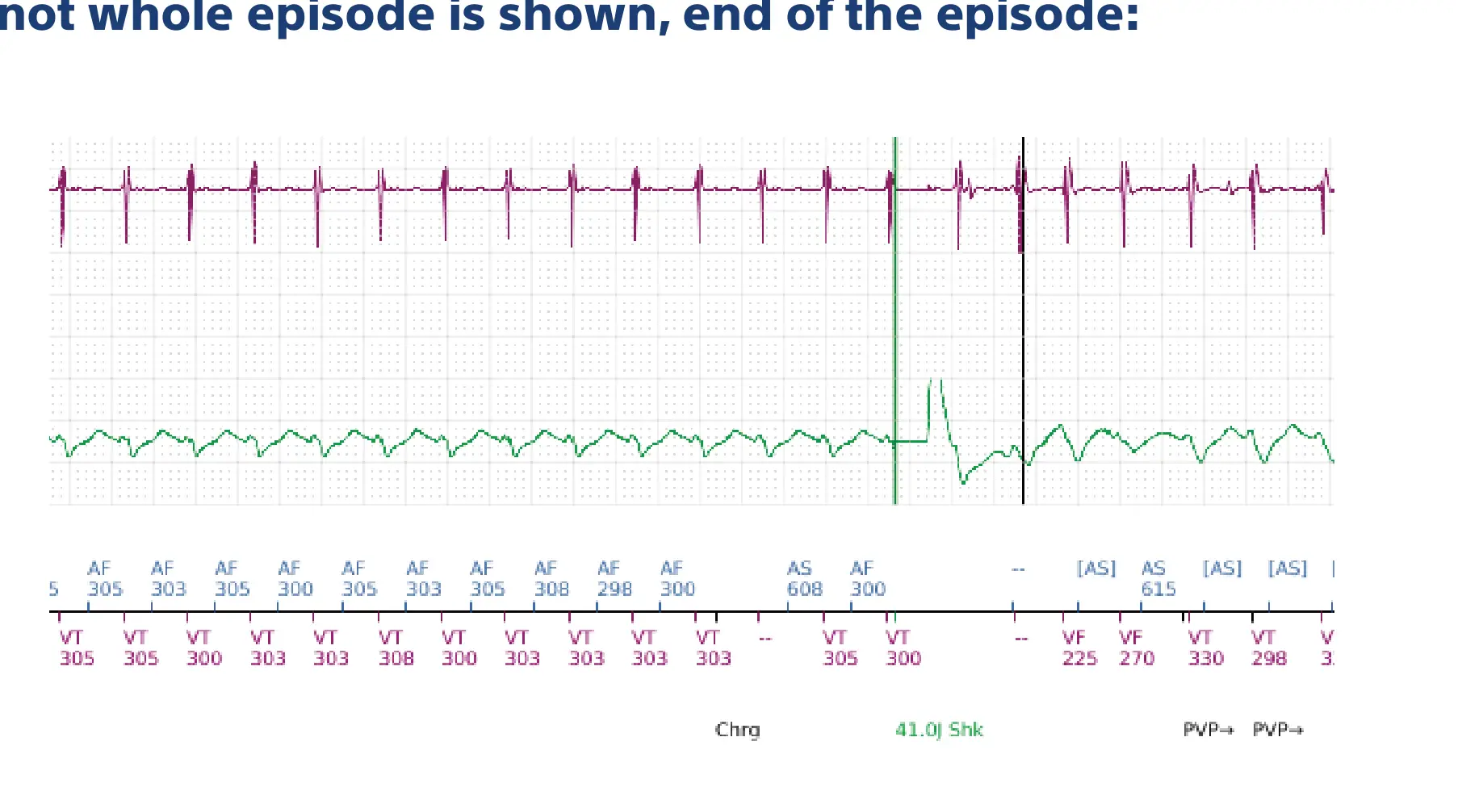 Boston Scientific ICD electrogram, segment 9 of 10 — Dual-chamber discrimination and discrimination error due to signal variability on the shock channel