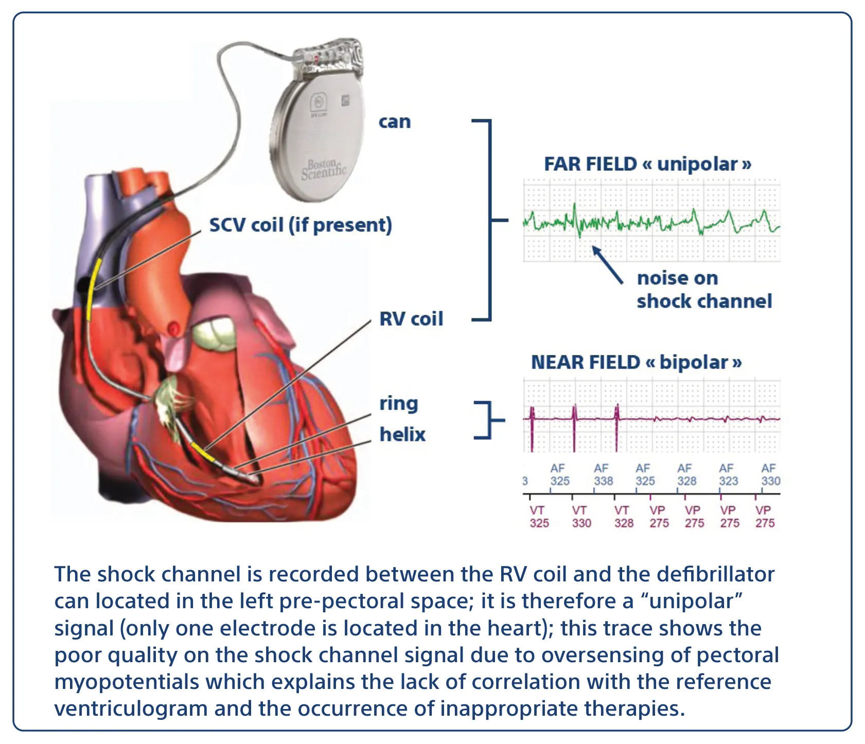 The shock channel is recorded between the RV coil and the defibrillator can located in the left pre-pectoral space; it is therefore a “unipolar” signal (only one electrode is located in the heart); this trace shows the poor quality on the shock channel signal due to oversensing of pectoral myopotentials which explains the lack of correlation with the reference ventriculogram and the occurrence of inappropriate therapies.