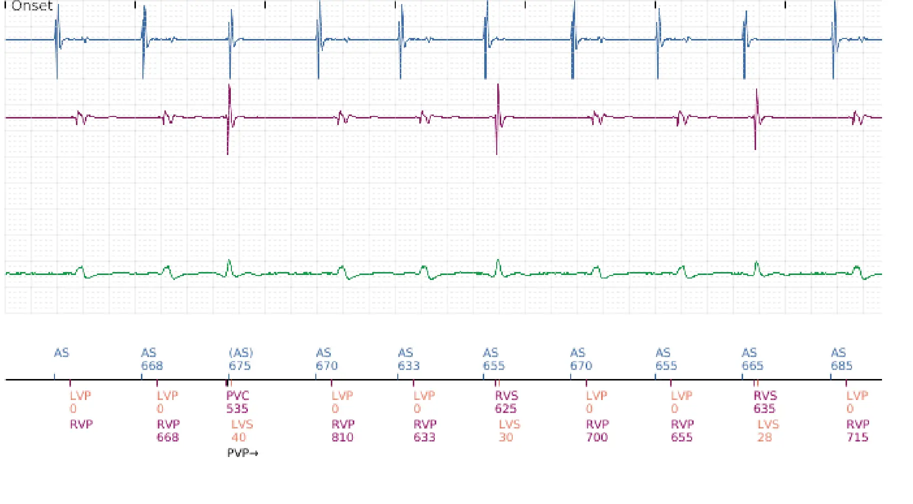 Boston Scientific ICD electrogram, segment 1 of 5 — Dual-chamber discrimination and discrimination error due to inappropriate programming of the correlation percentage