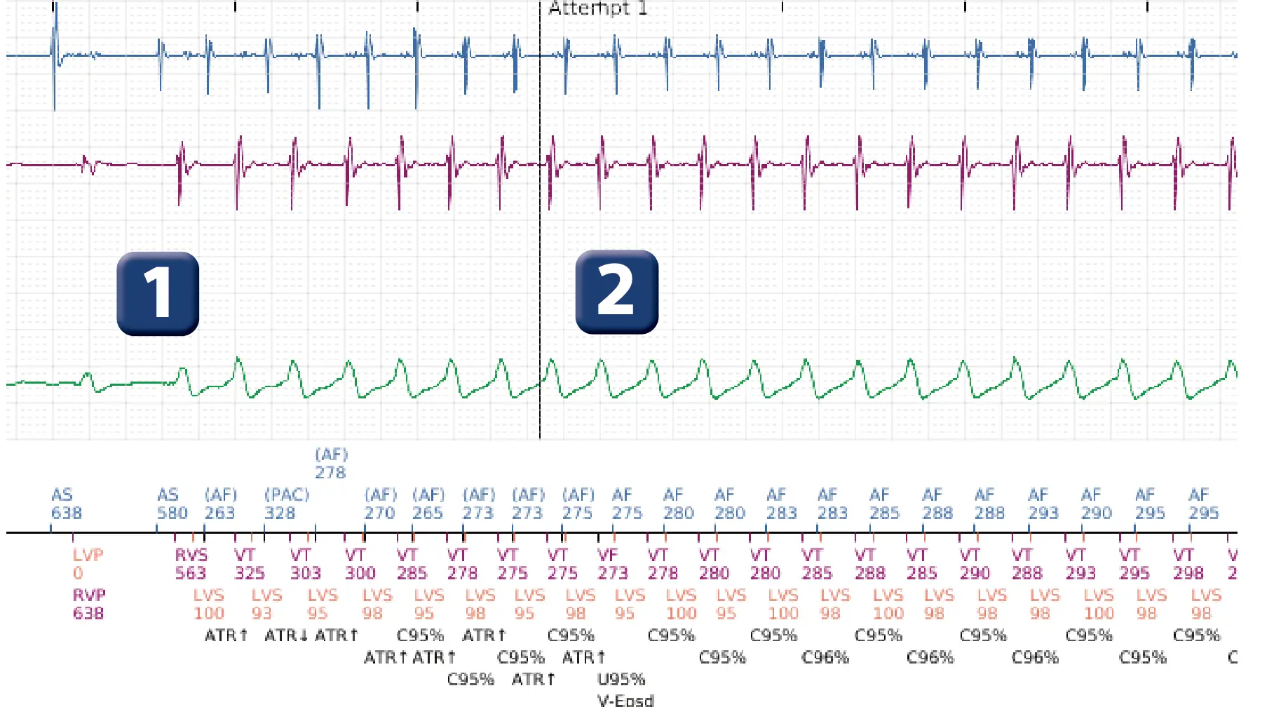 Boston Scientific ICD electrogram, segment 2 of 5 — Dual-chamber discrimination and discrimination error due to inappropriate programming of the correlation percentage