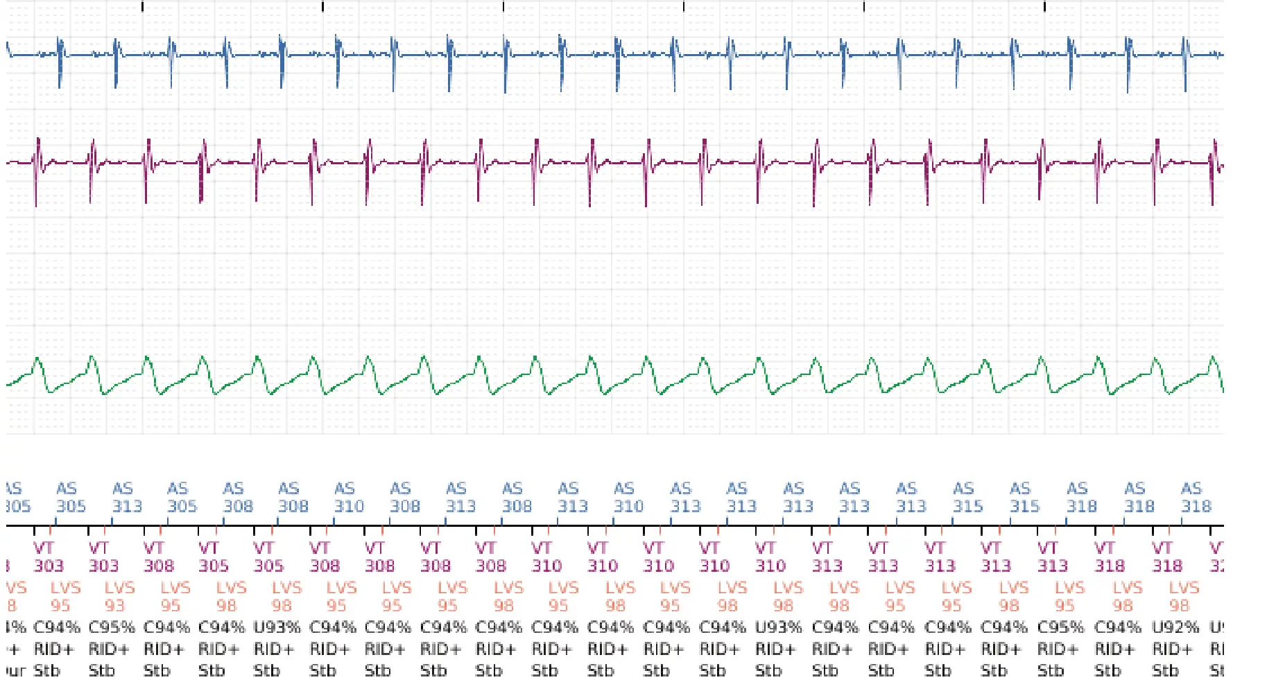 Boston Scientific ICD electrogram, segment 4 of 5 — Dual-chamber discrimination and discrimination error due to inappropriate programming of the correlation percentage