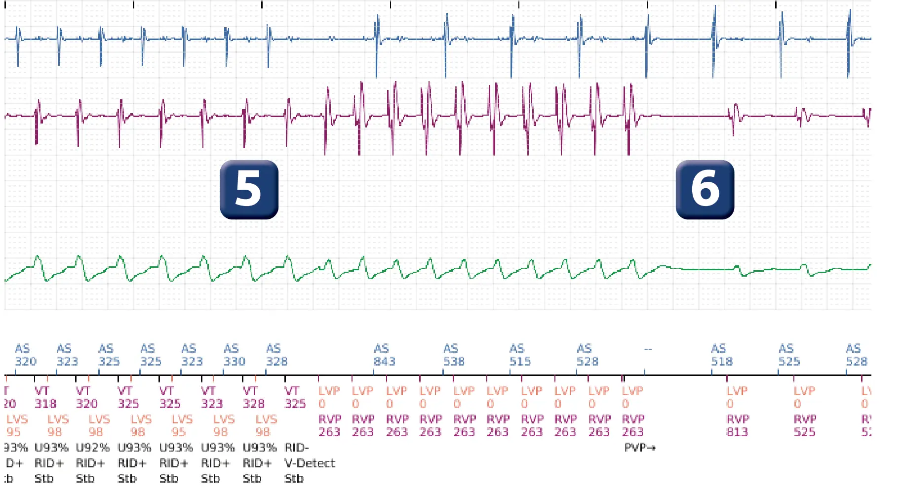 Boston Scientific ICD electrogram, segment 5 of 5 — Dual-chamber discrimination and discrimination error due to inappropriate programming of the correlation percentage