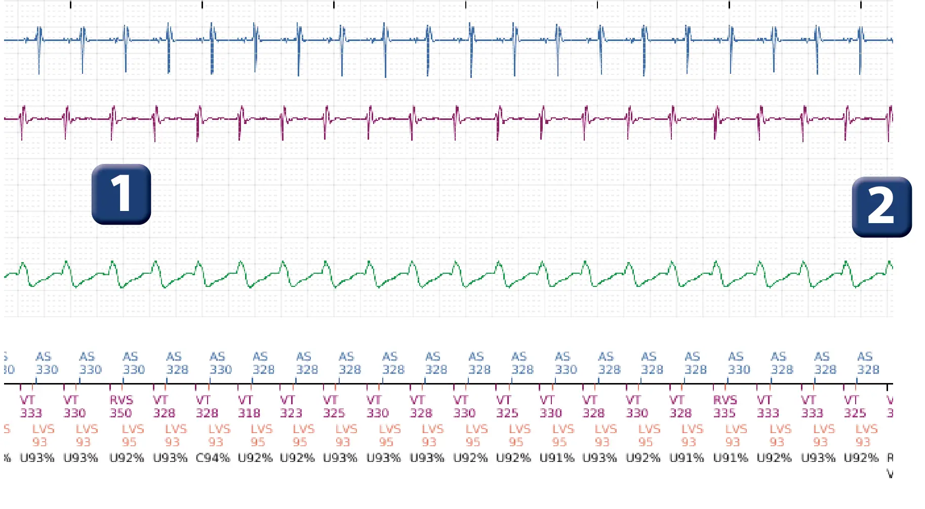 Boston Scientific ICD electrogram, segment 1 of 3 — Dual-chamber discrimination and discrimination error due to inappropriate programming of the correlation percentage