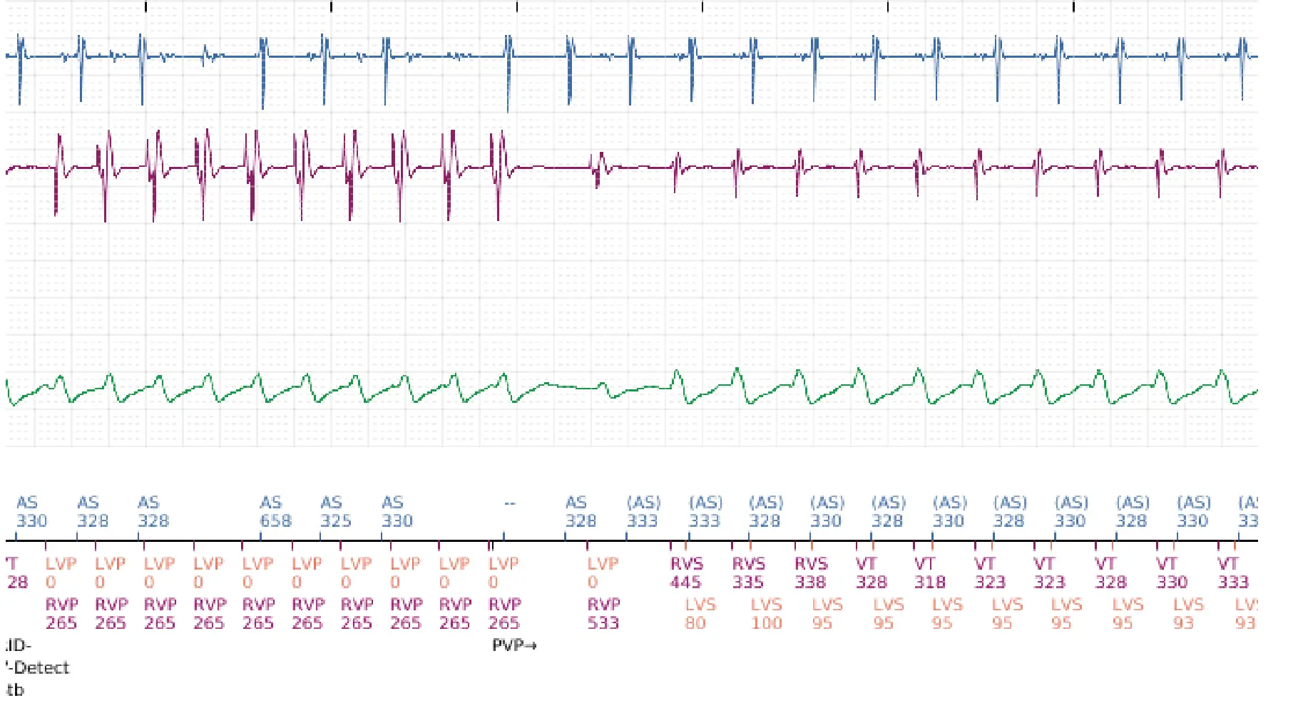Boston Scientific ICD electrogram, segment 2 of 3 — Dual-chamber discrimination and discrimination error due to inappropriate programming of the correlation percentage