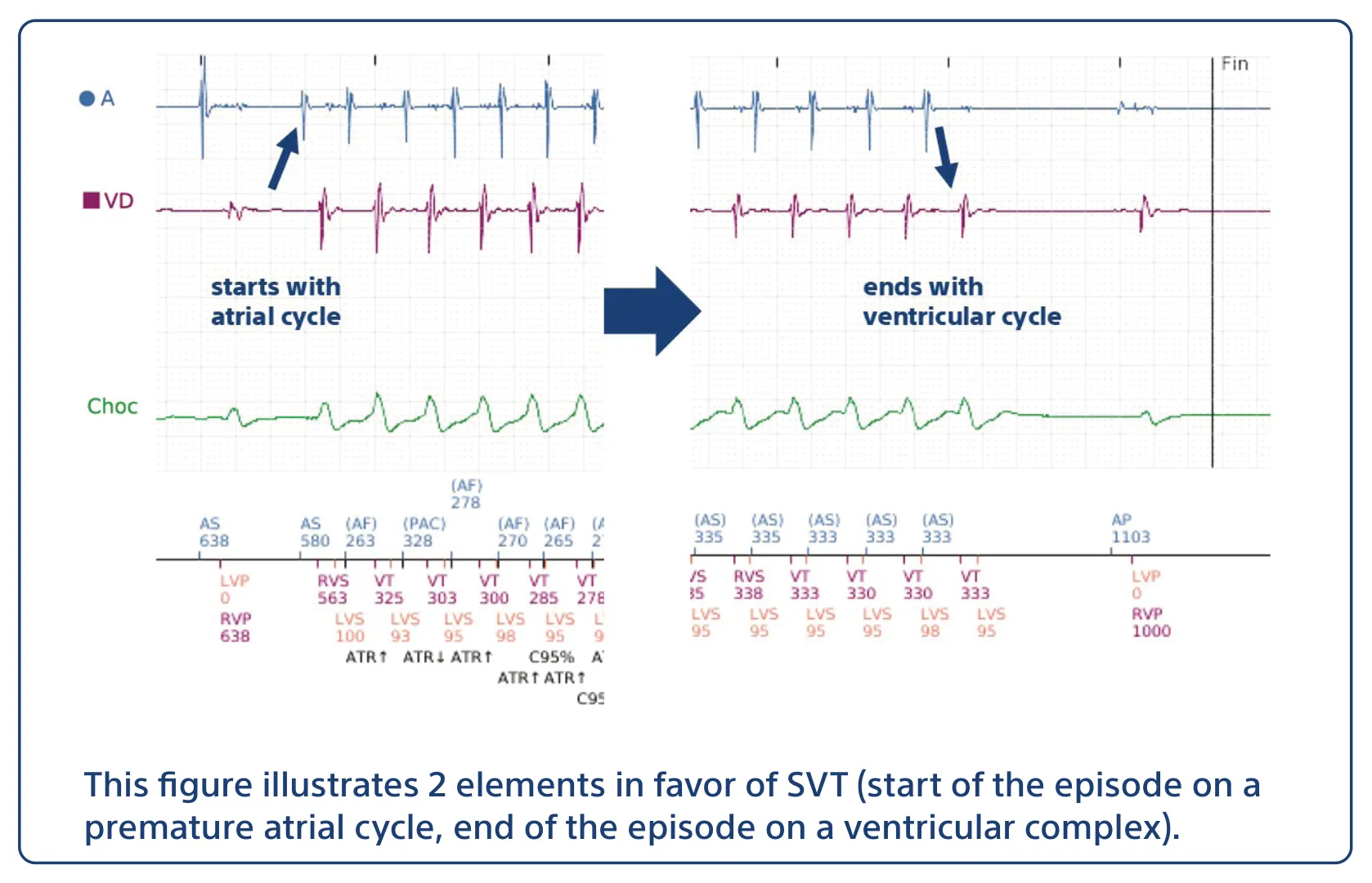This figure illustrates 2 elements in favor of SVT (start of the episode on a premature atrial cycle, end of the episode on a ventricular complex).