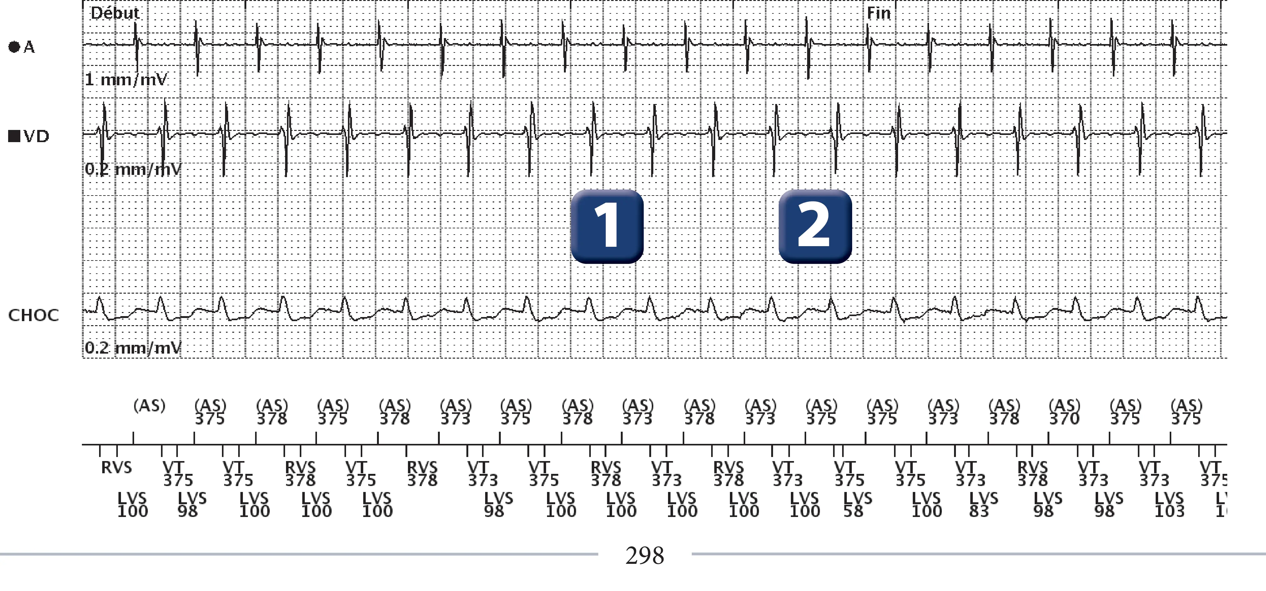 Boston Scientific ICD electrogram, segment 1 of 3 — Dual-chamber discrimination, atrial tachycardia