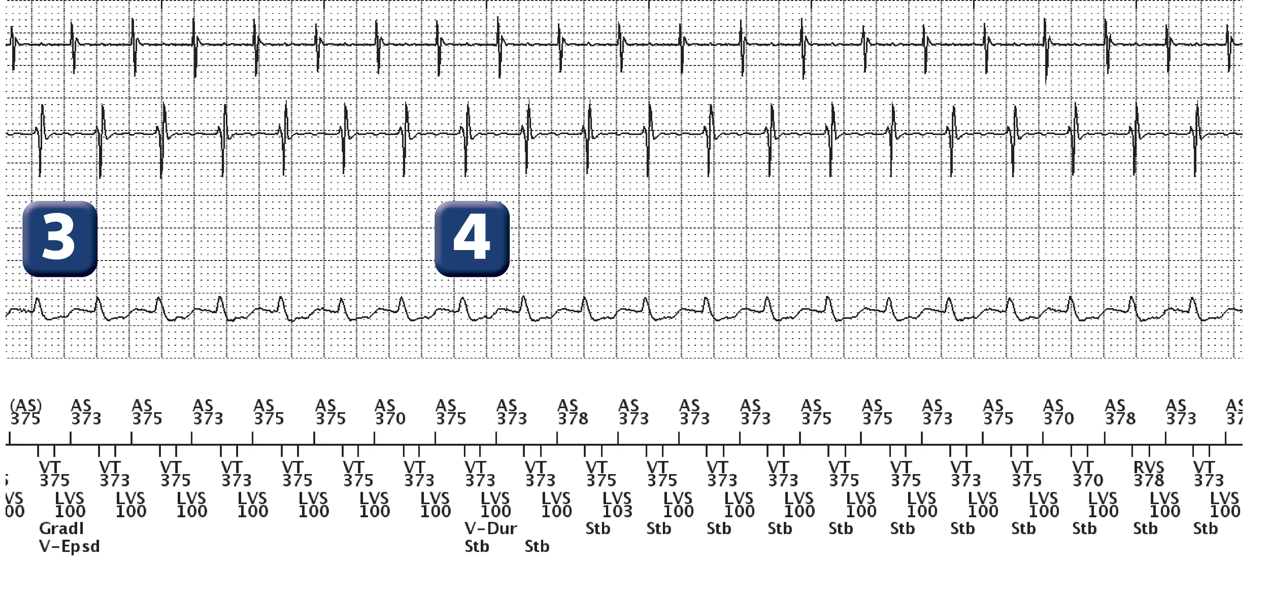 Boston Scientific ICD electrogram, segment 2 of 3 — Dual-chamber discrimination, atrial tachycardia