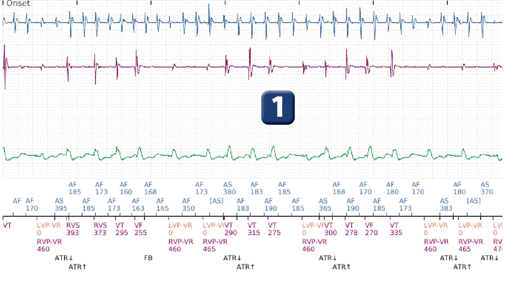 Boston Scientific ICD electrogram, segment 1 of 12 — Dual-chamber discrimination and atrial fibrillation