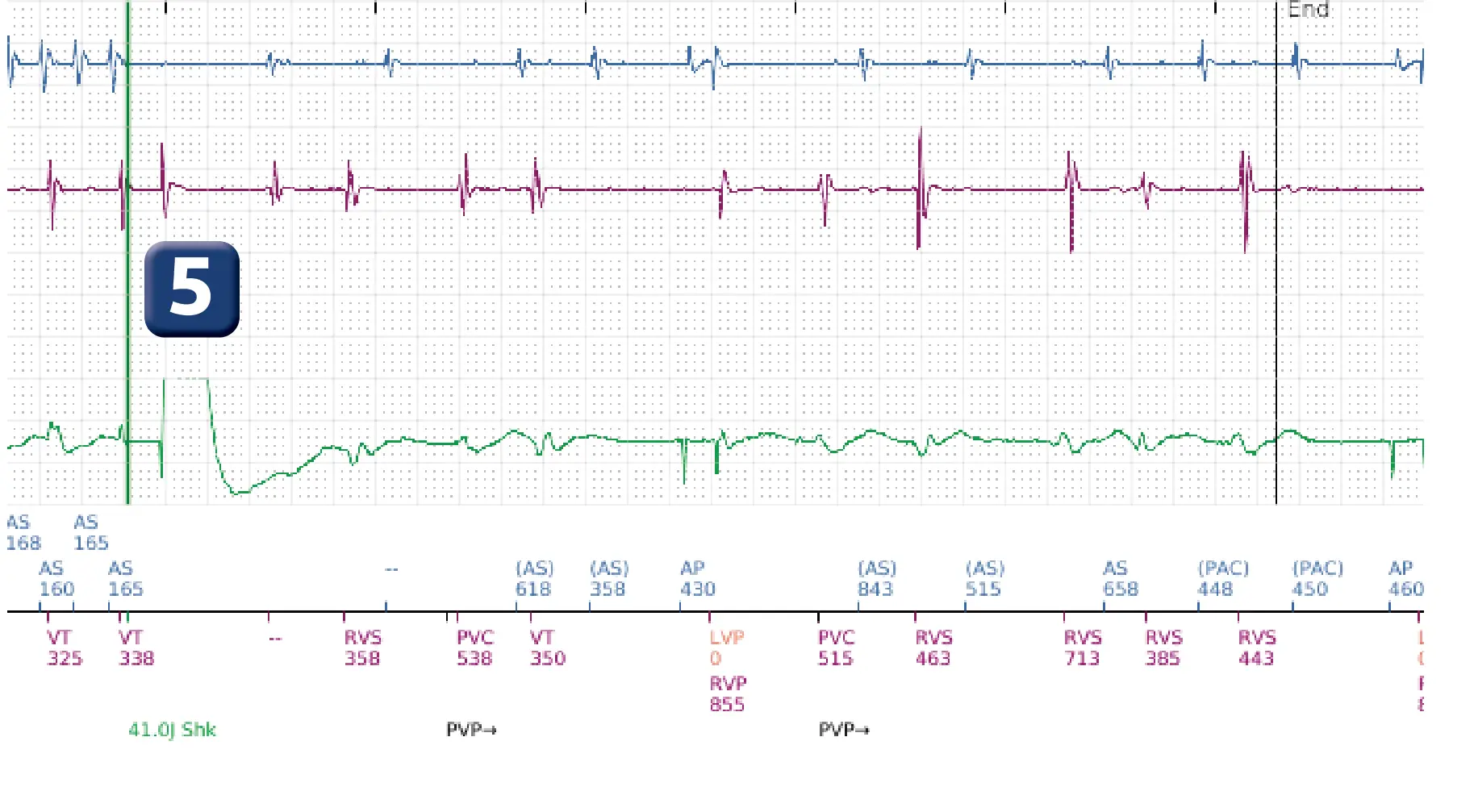 Boston Scientific ICD electrogram, segment 12 of 12 — Dual-chamber discrimination and atrial fibrillation