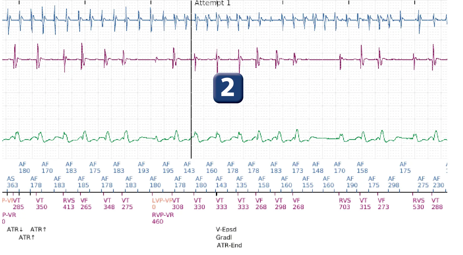 Boston Scientific ICD electrogram, segment 2 of 12 — Dual-chamber discrimination and atrial fibrillation