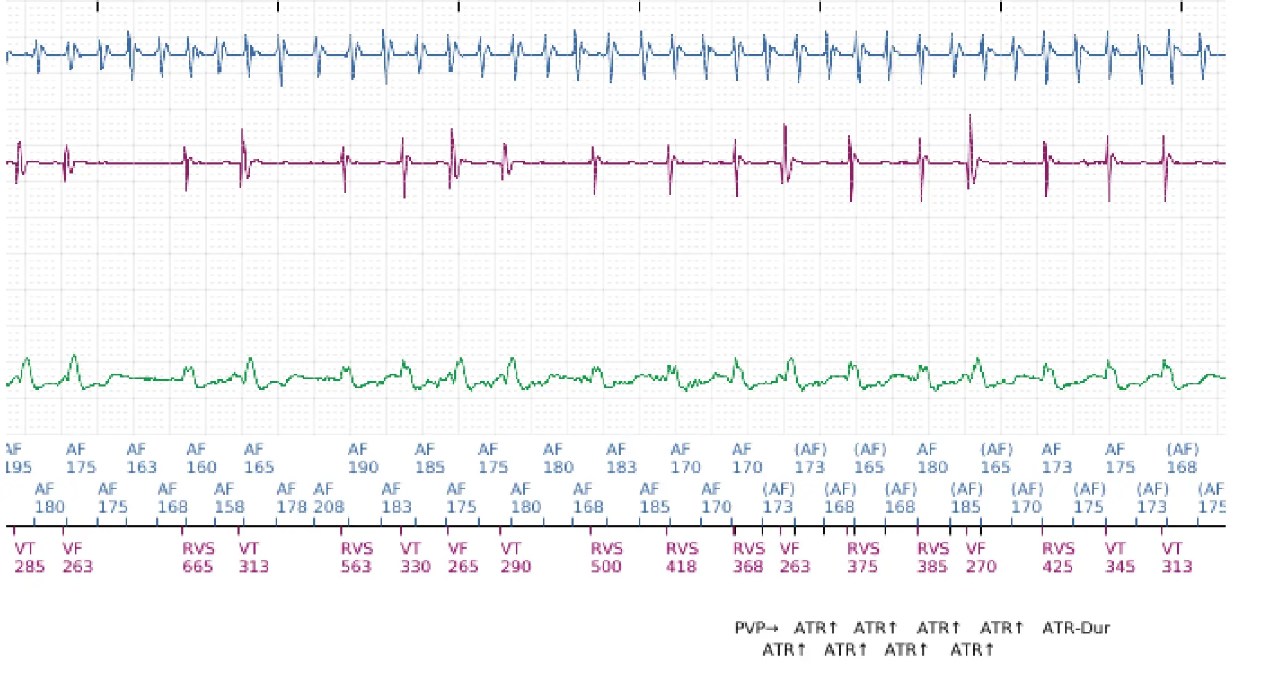 Boston Scientific ICD electrogram, segment 3 of 12 — Dual-chamber discrimination and atrial fibrillation