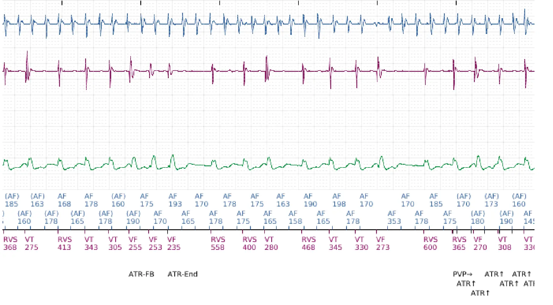 Boston Scientific ICD electrogram, segment 4 of 12 — Dual-chamber discrimination and atrial fibrillation