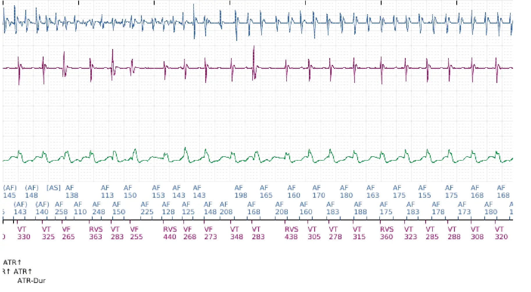 Boston Scientific ICD electrogram, segment 5 of 12 — Dual-chamber discrimination and atrial fibrillation