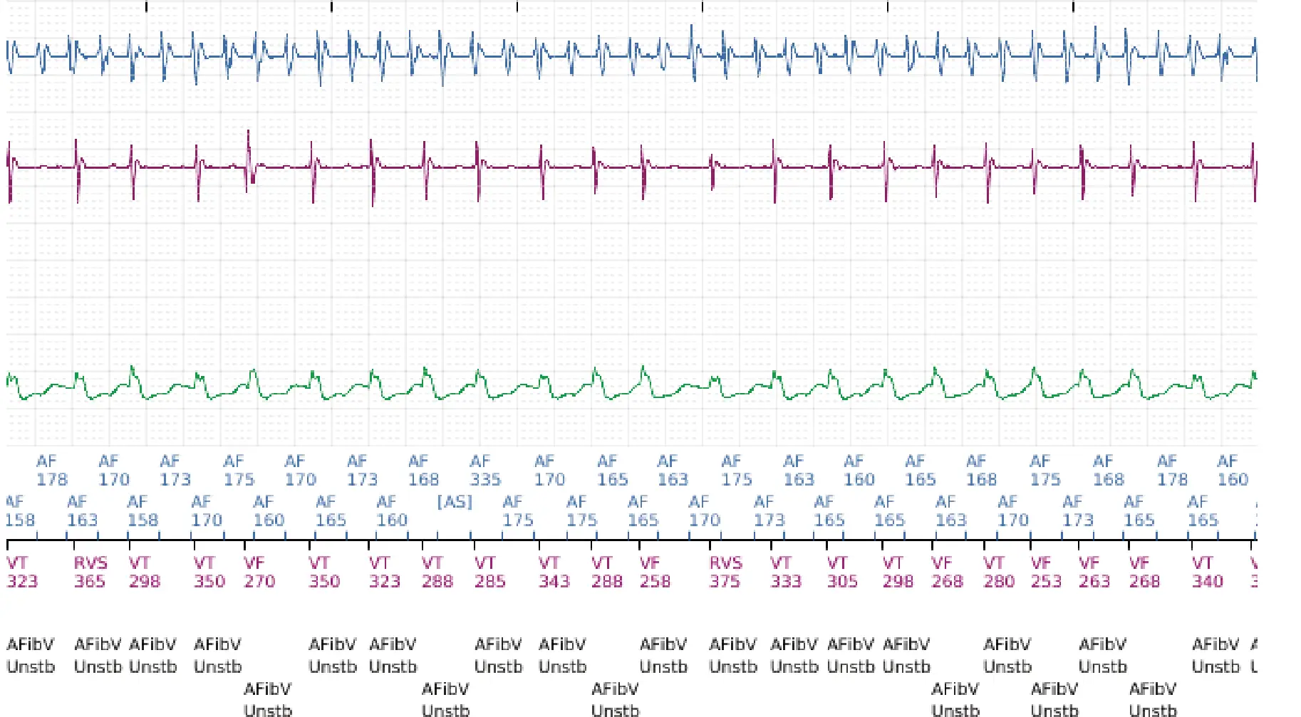 Boston Scientific ICD electrogram, segment 8 of 12 — Dual-chamber discrimination and atrial fibrillation