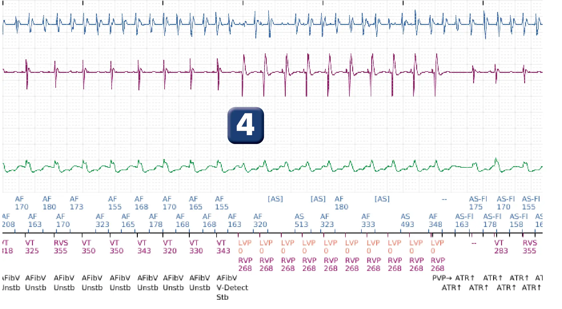 Boston Scientific ICD electrogram, segment 9 of 12 — Dual-chamber discrimination and atrial fibrillation